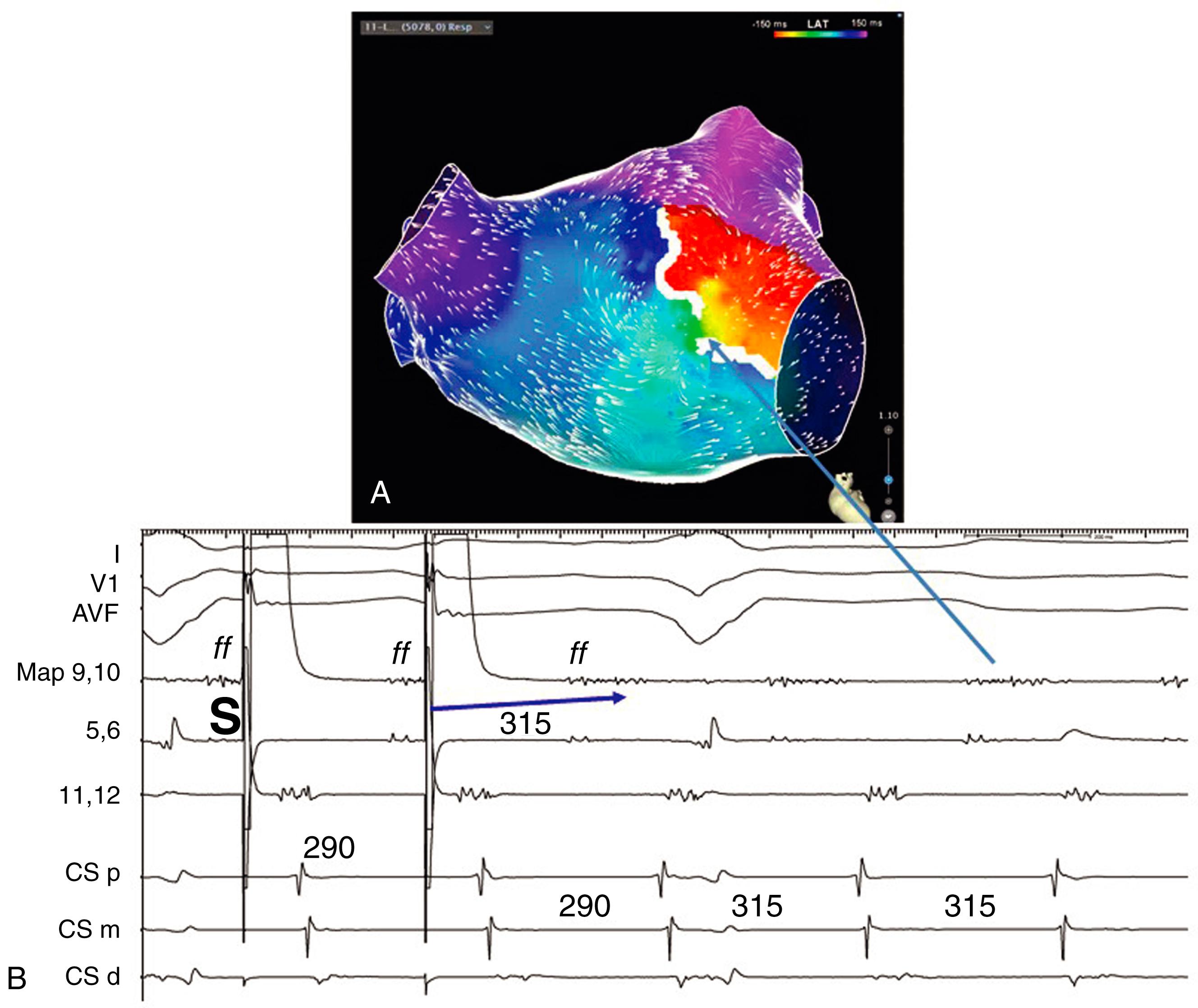 Fig. 129.4, Macroreentrant left atrial tachycardia.