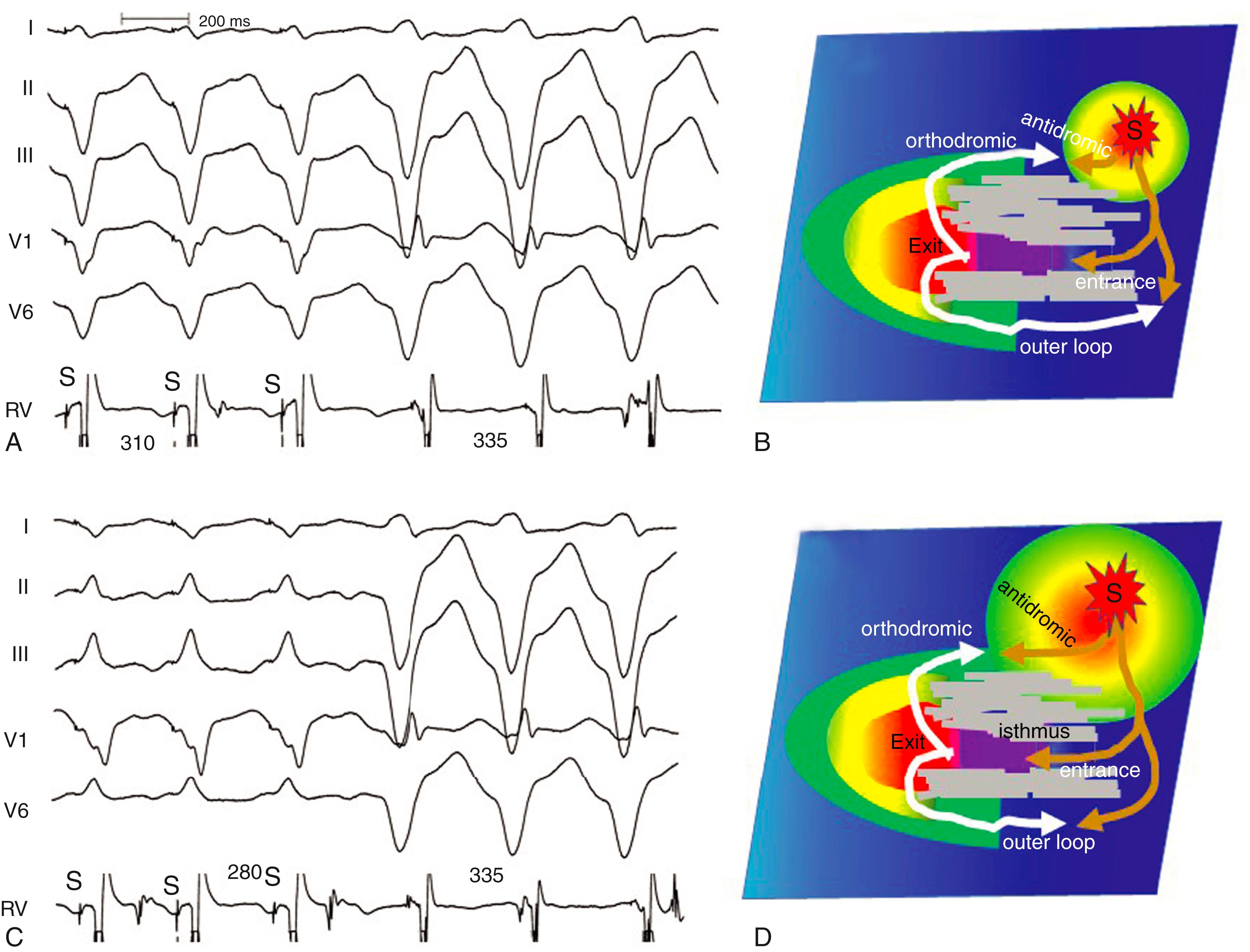 Fig. 129.5, Entrainment of ventricular tachycardia.