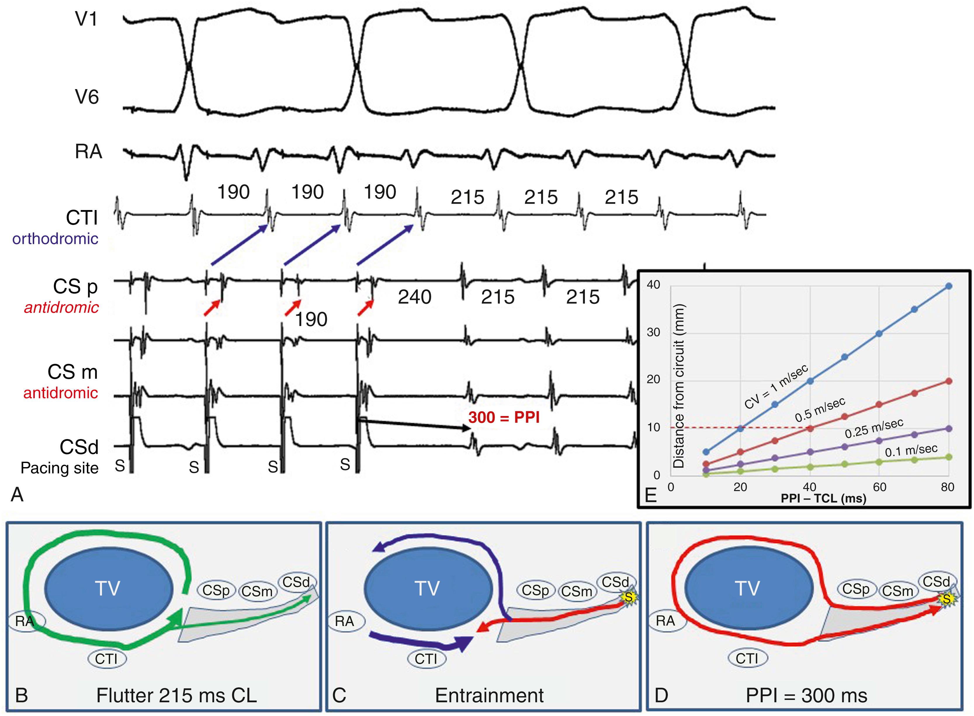 Fig. 129.6, Entrainment of common atrial flutter during pacing from the coronary sinus (CS) illustrating orthodromic and antidromic capture sites consistent with fusion that cannot be easily appreciated from the surface electrocardiogram.