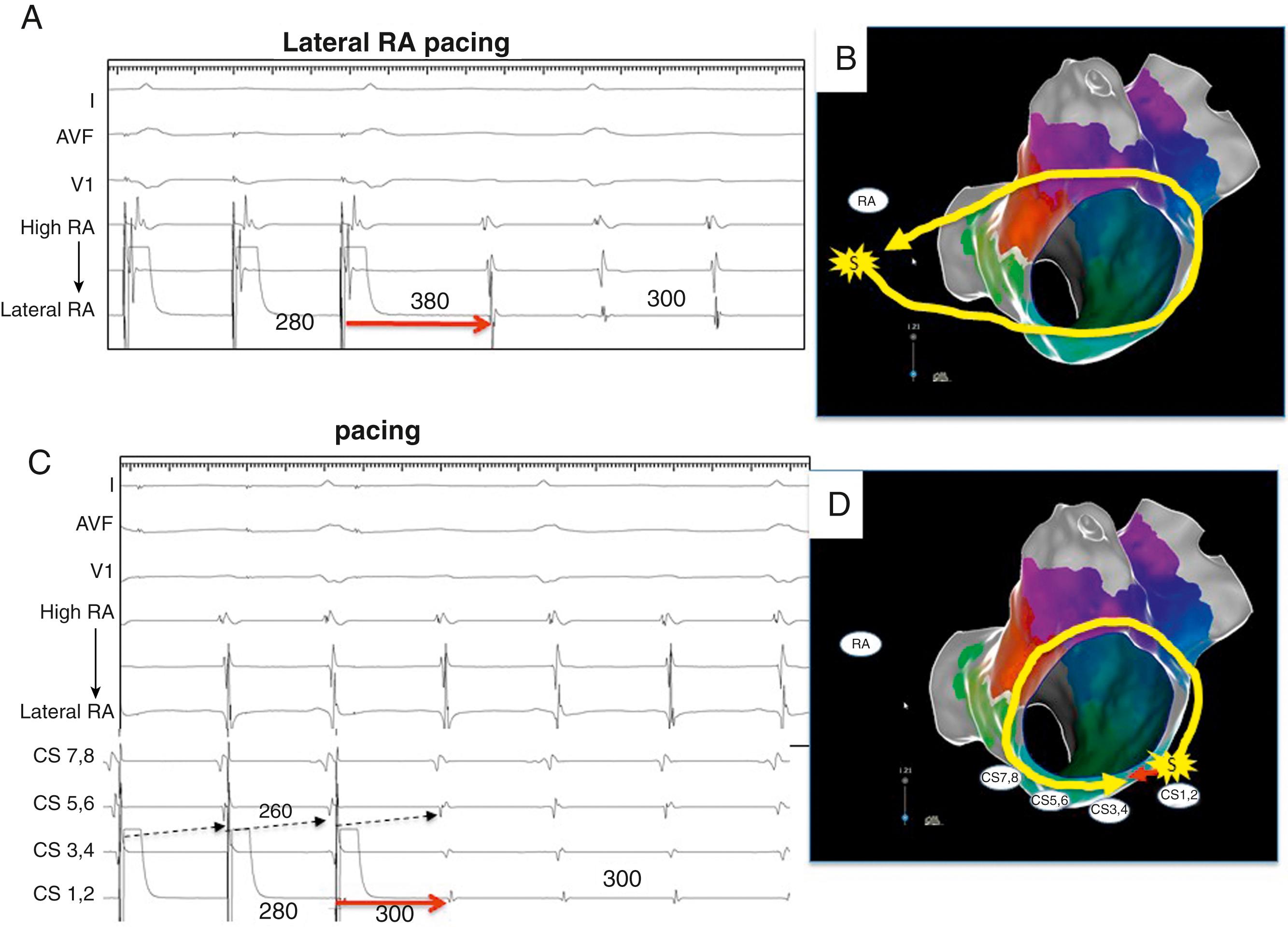 Fig. 129.7, Entrainment of perimitral flutter from sites remote (A) and within (B) the reentry circuit.