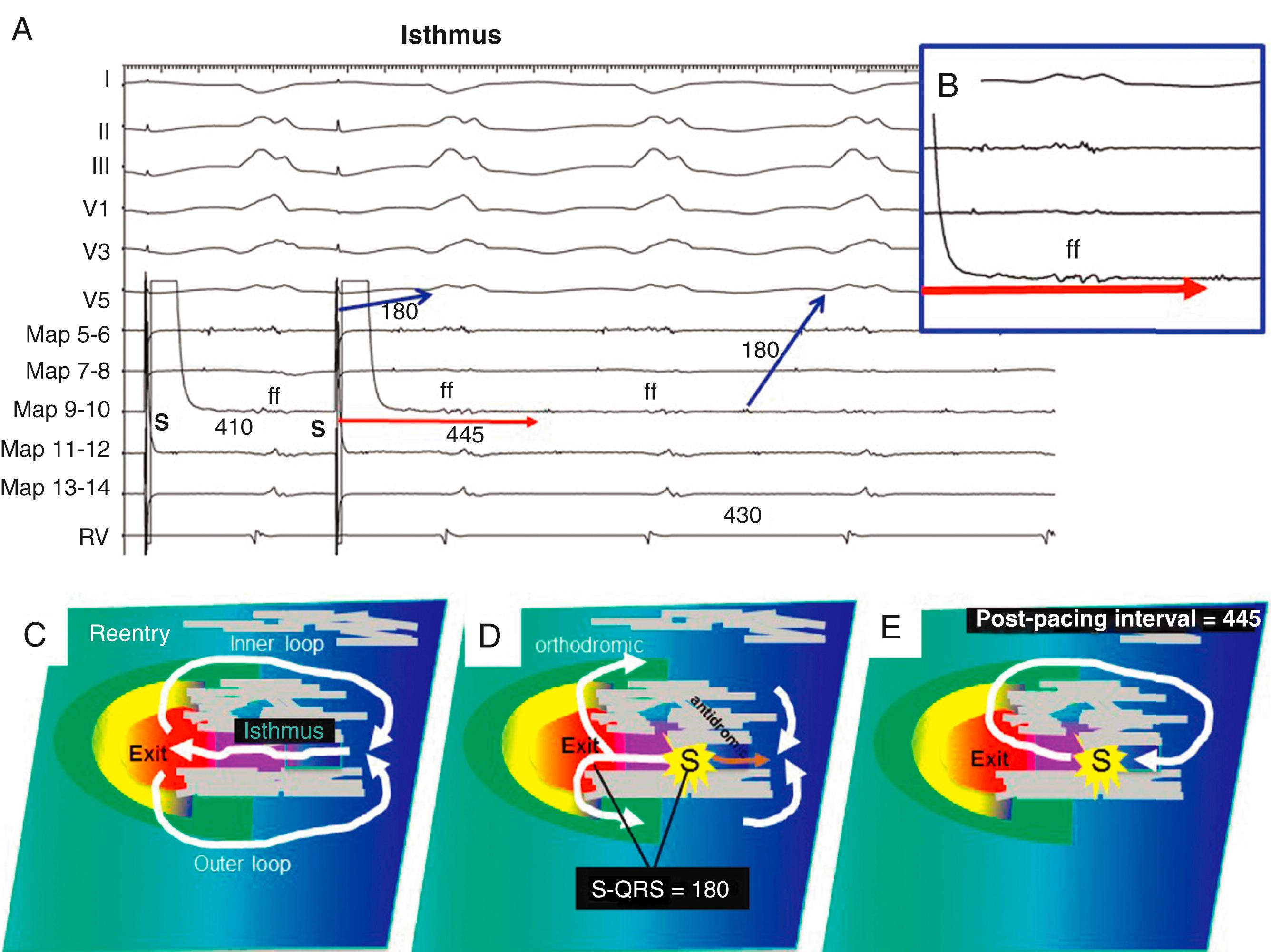 Fig. 129.8, Entrainment of a postinfarct ventricular tachycardia (VT) from an isthmus site.