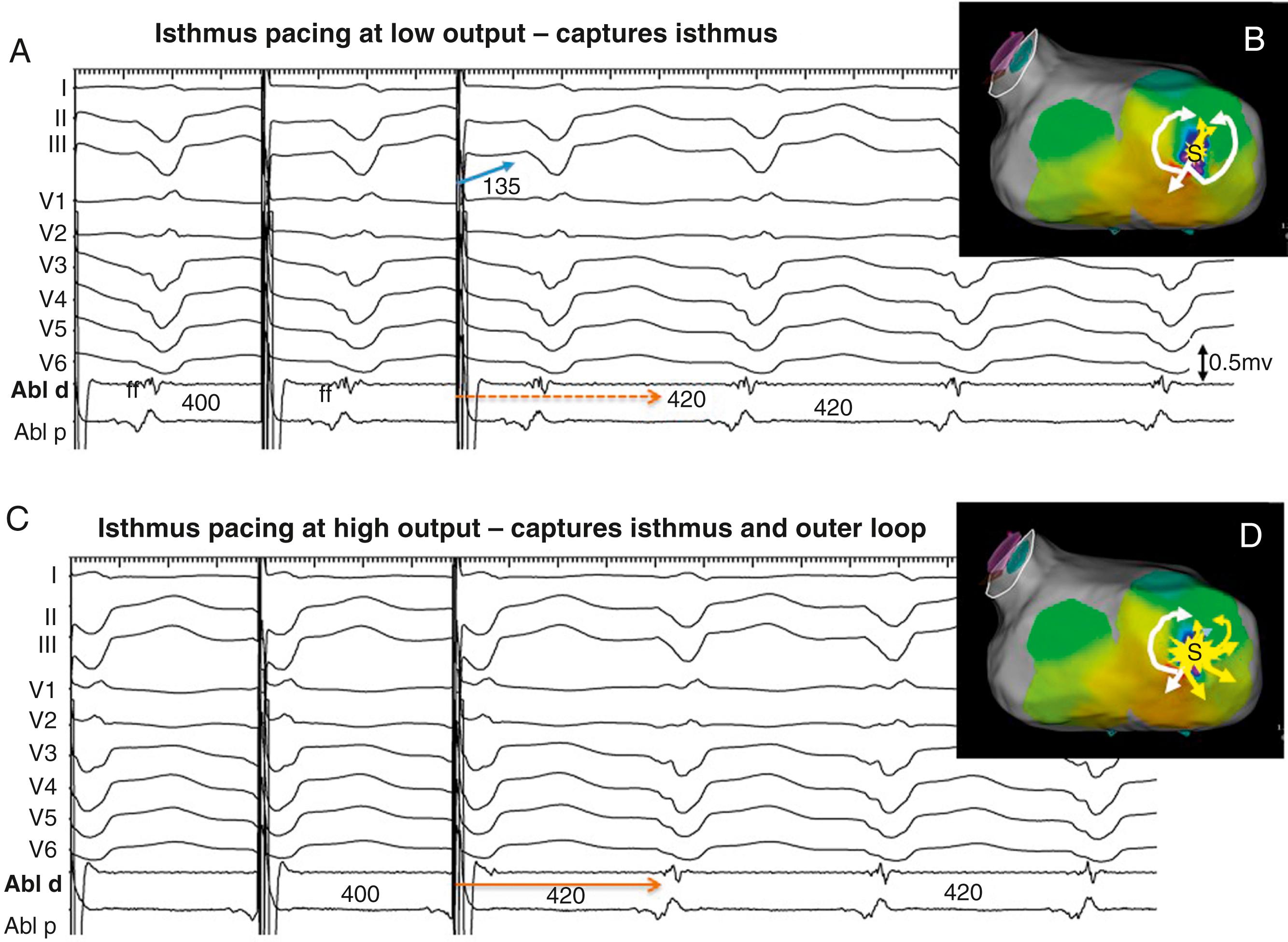 Fig. 129.11, Entrainment from an isthmus site for the same ventricular tachycardia (VT) shown in Figs. 129.2, 129.9, and 129.10