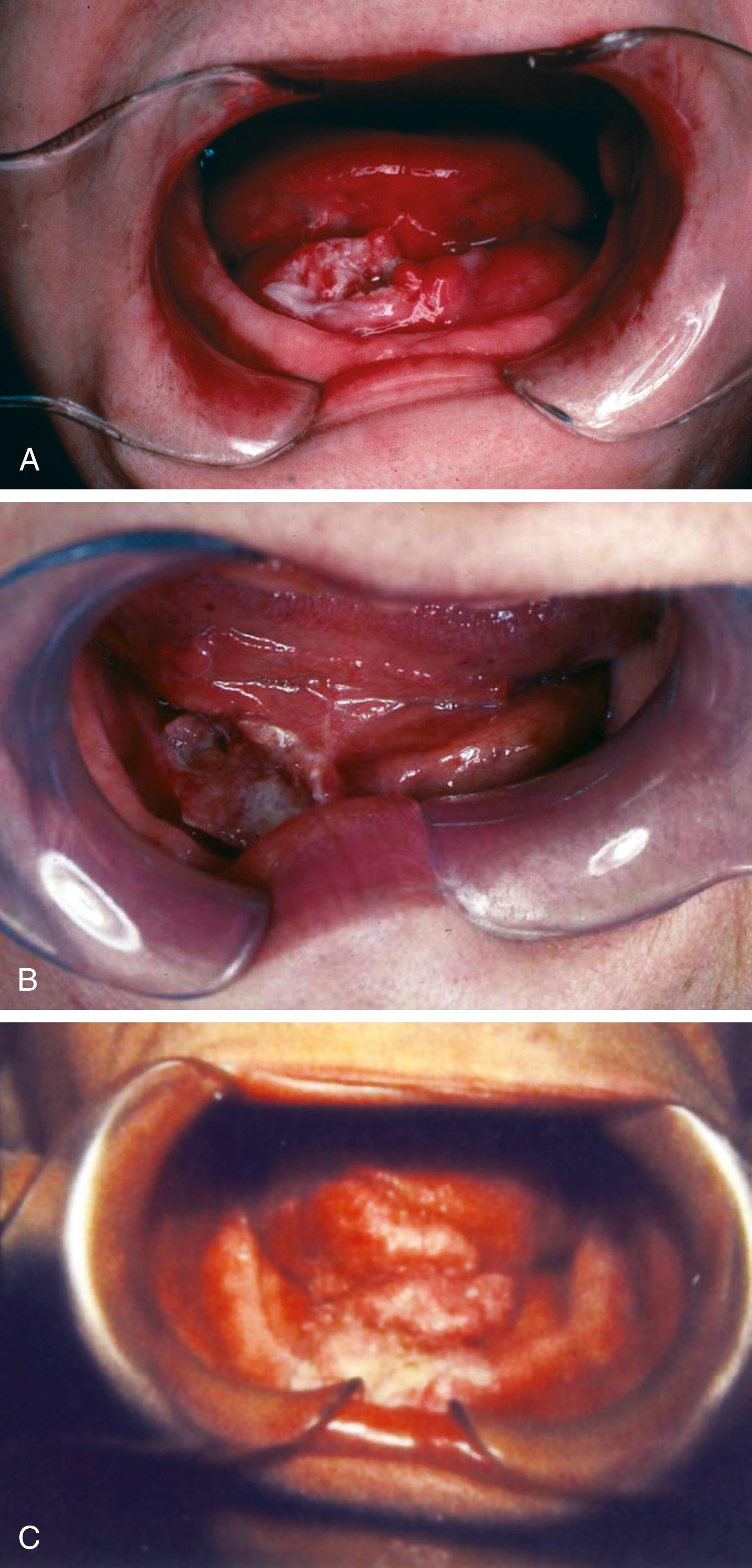 Fig. 181.1, A, Cancer of the floor of the mouth too close to the mandible to resect without marginal mandibulectomy. B, A tumor adherent to the mandibular periosteum. C, A tumor crossing but not invading the mandible.