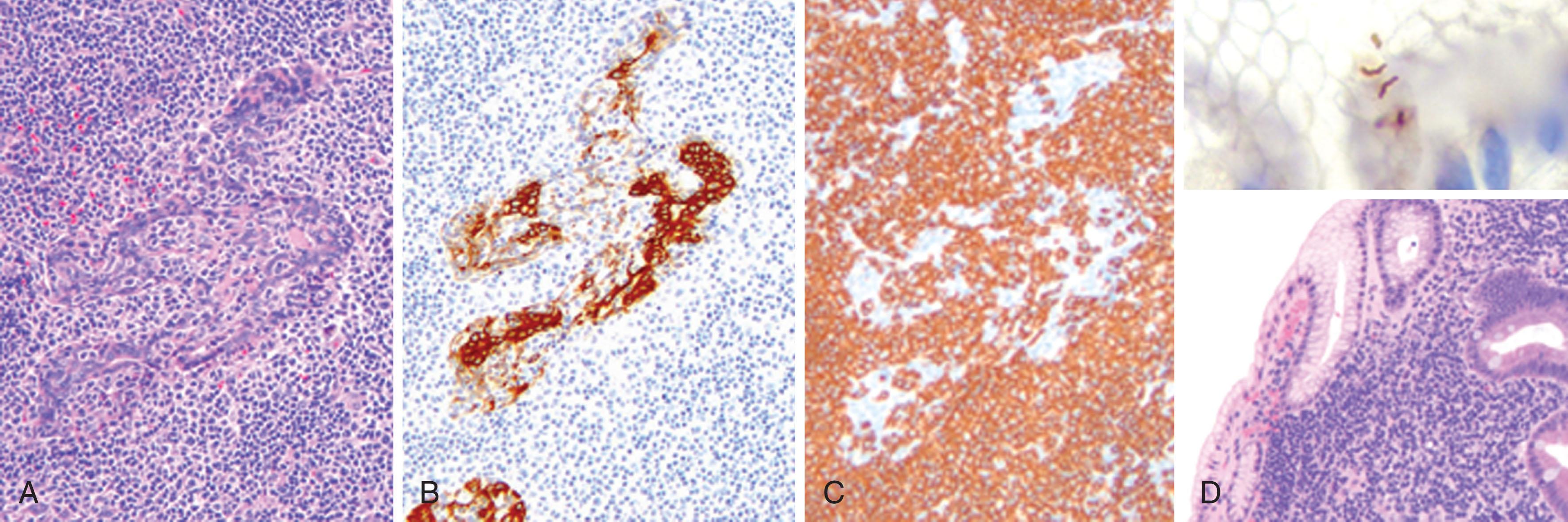 Figure 83.2, EXTRANODAL MARGINAL ZONE LYMPHOMAS OF MUCOSA-ASSOCIATED LYMPHOID TISSUE (MALT LYMPHOMAS).