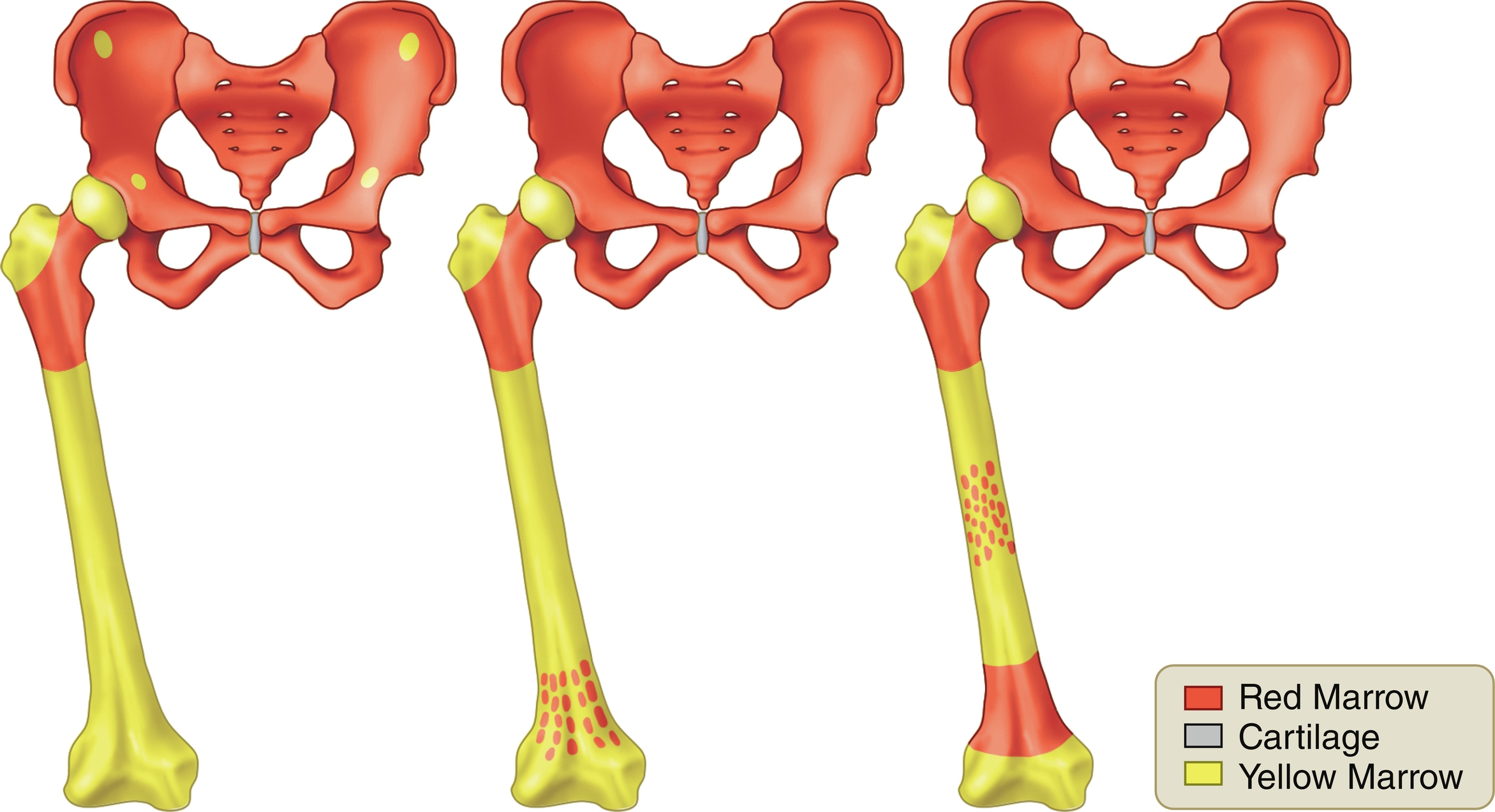 Fig. 2.11, Marrow proliferative disorders: reconversion.