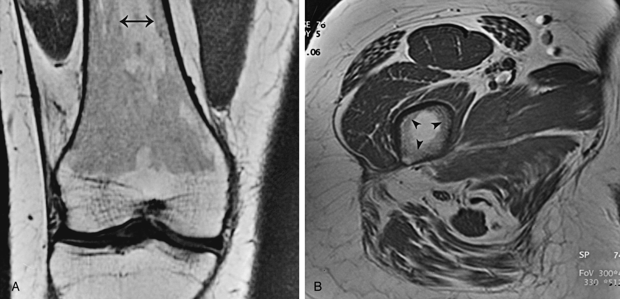 Fig. 2.4, Normal red marrow: variation in pattern.