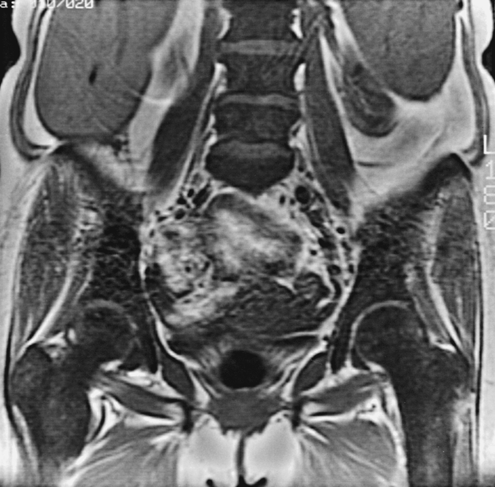 Fig. 2.8, Marrow proliferative disorders: mastocytosis.