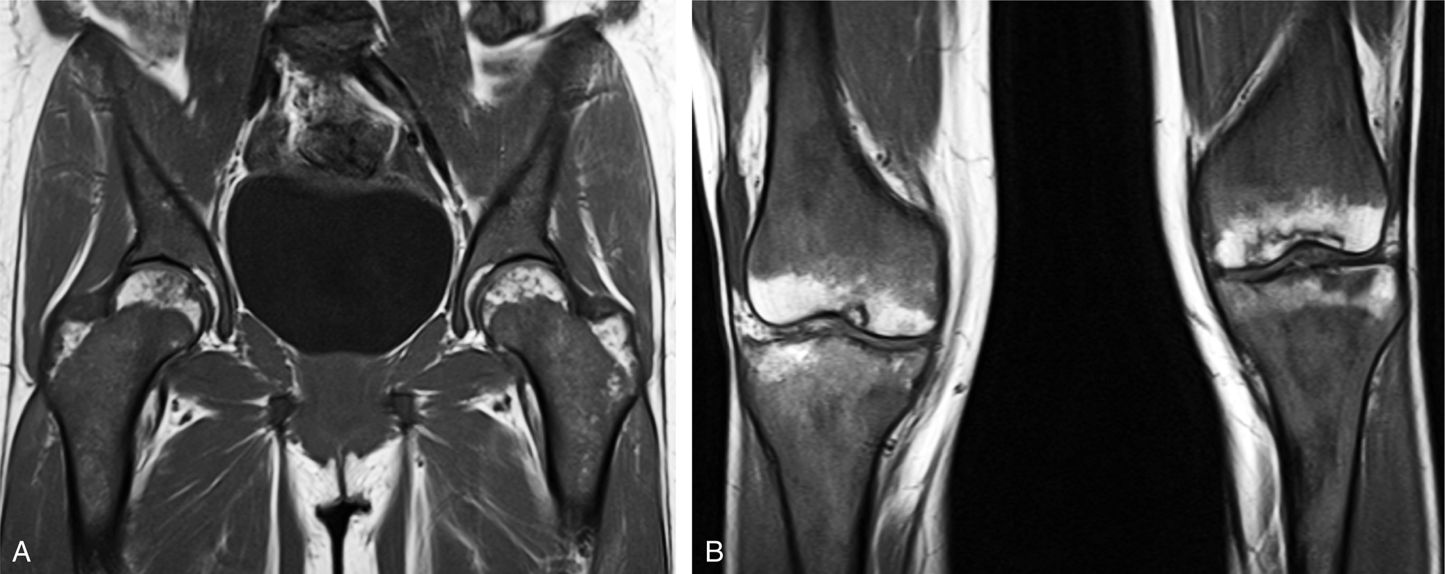 Fig. 2.9, Marrow proliferative disorders: reconversion due to sickle cell anemia.