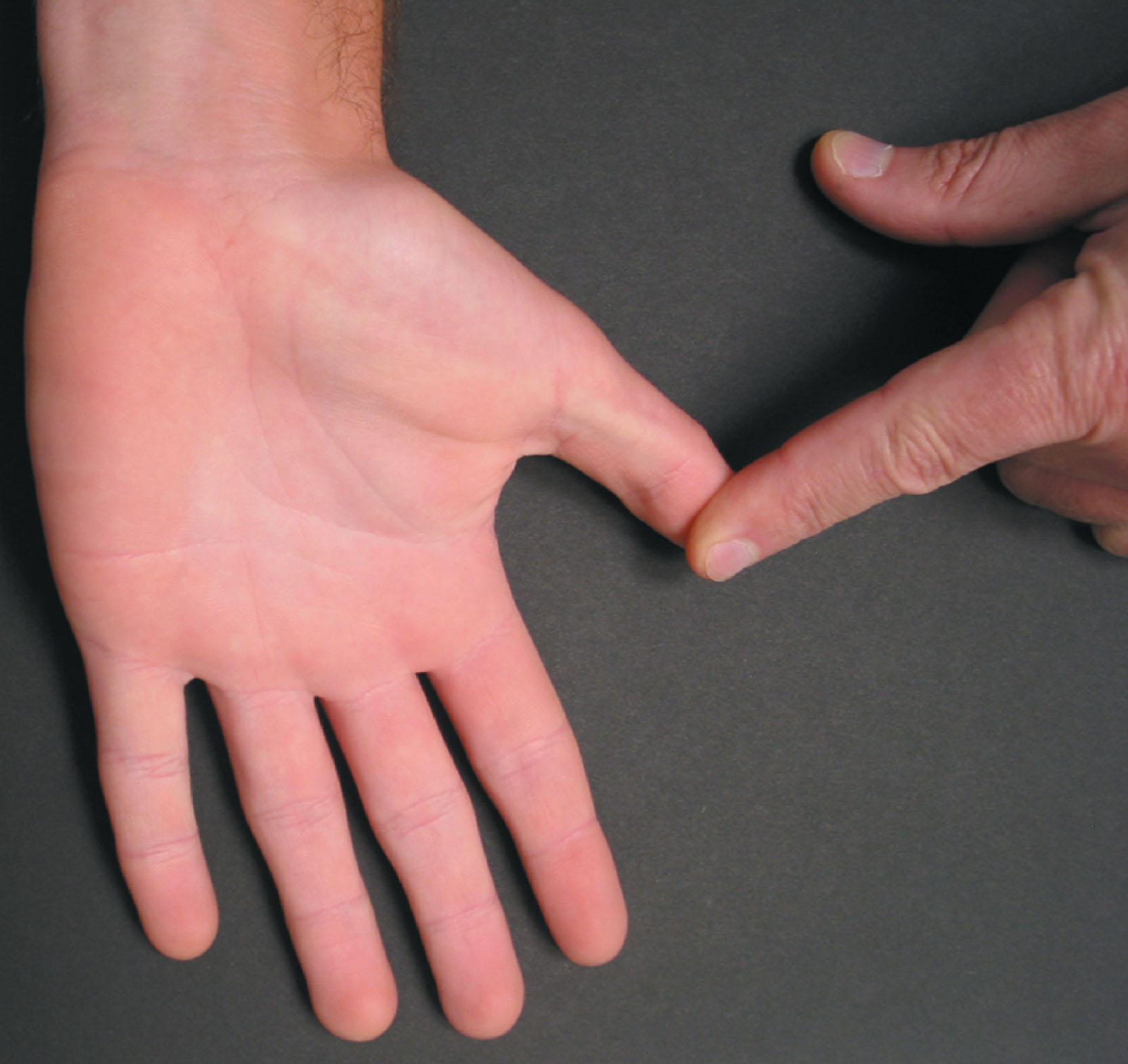 Fig. 7.1, The Watson stress test for arthritis of the carpometacarpal joint of the thumb.