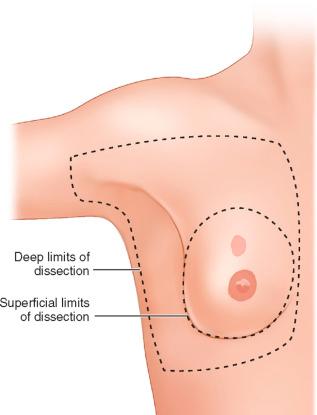 F igure 48-3-1, Diagram showing limits of dissection.
