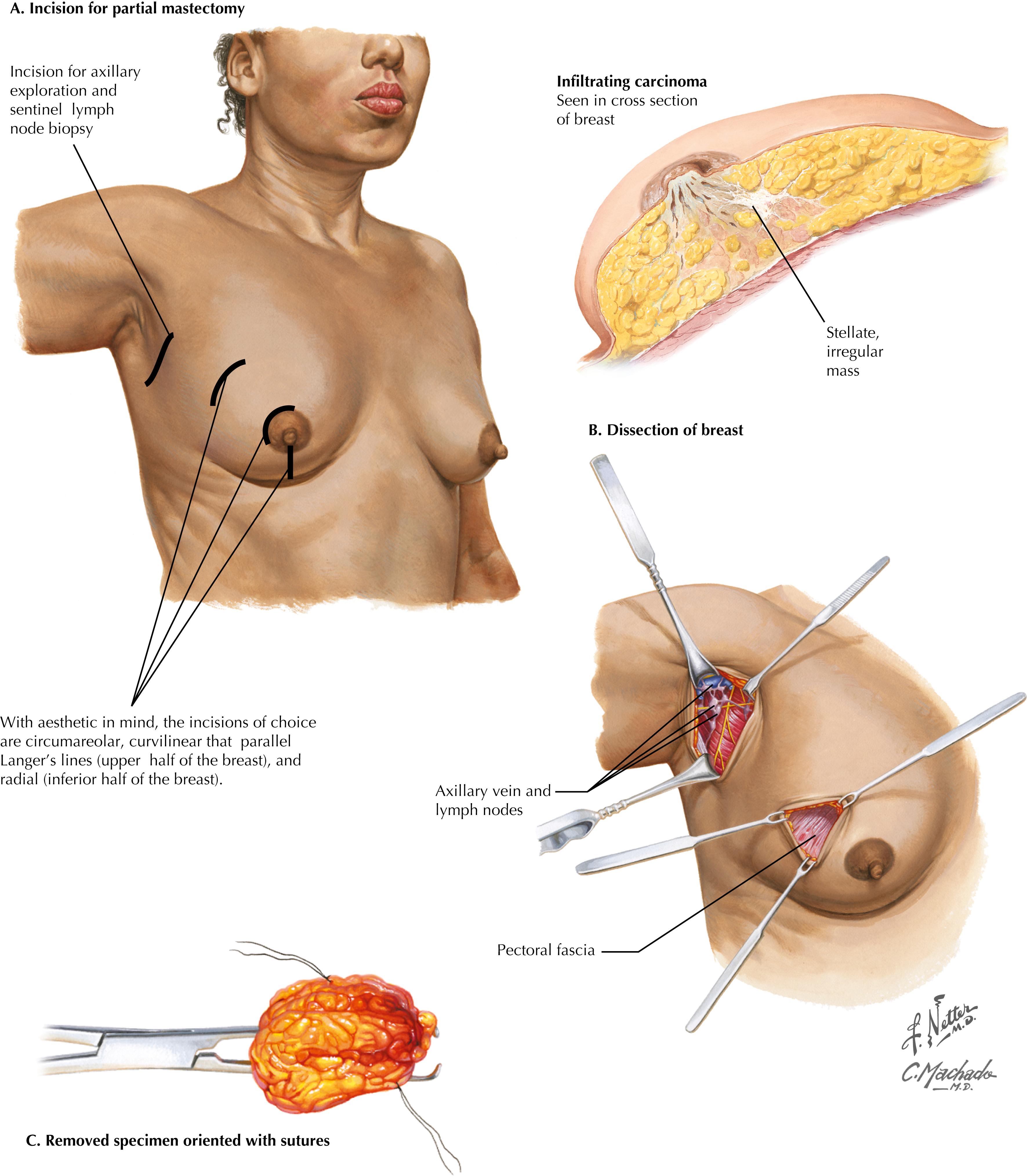 FIGURE 55.1, Partial mastectomy.