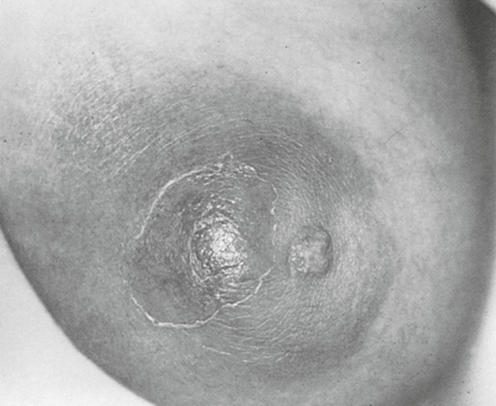 Fig. 15.1, A 38-year-old smoker presented with acute onset of right breast pain. A red, hot, tender, fluctuant mass was observed.