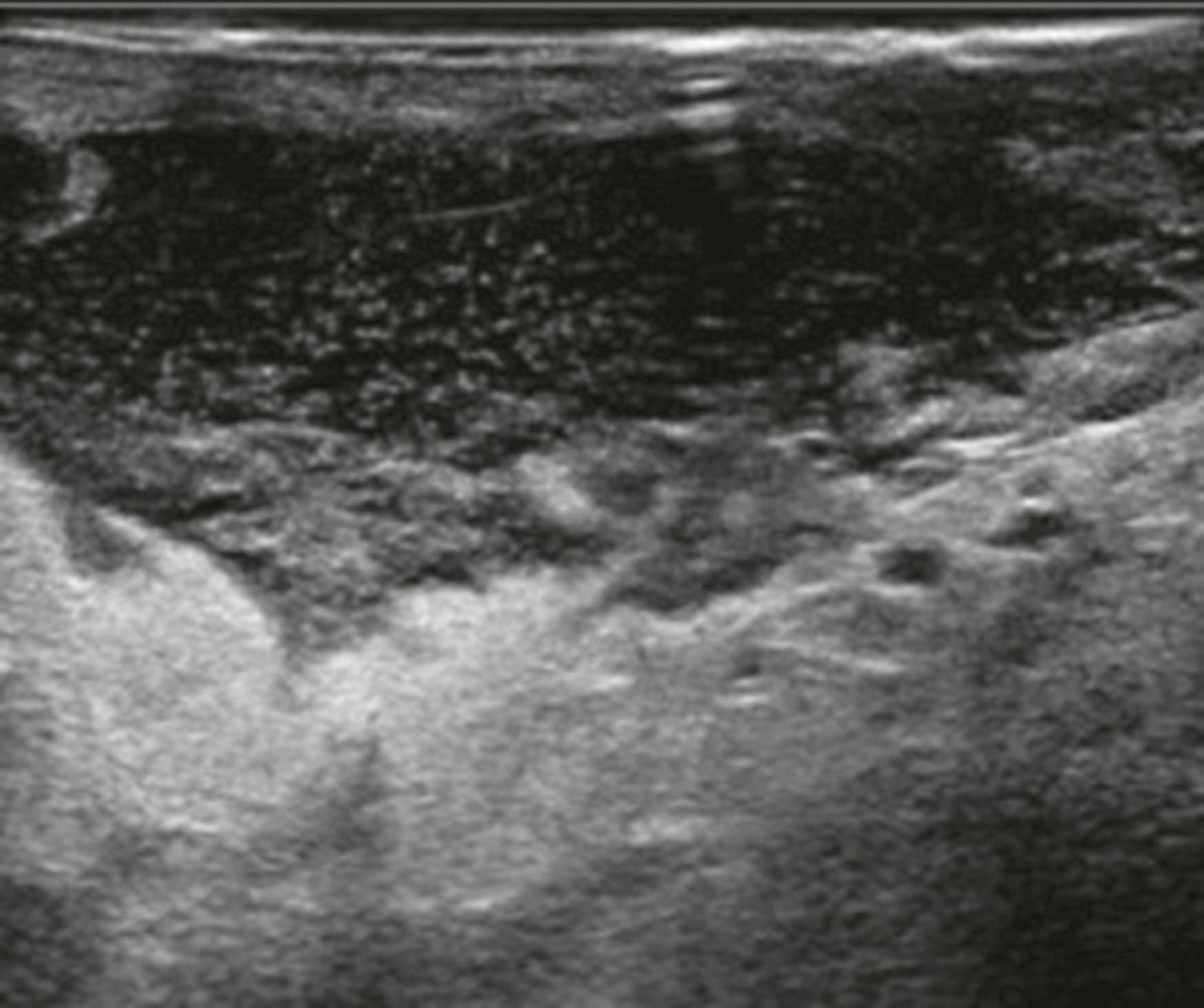 Fig. 15.2, Ultrasound showing breast abscess.