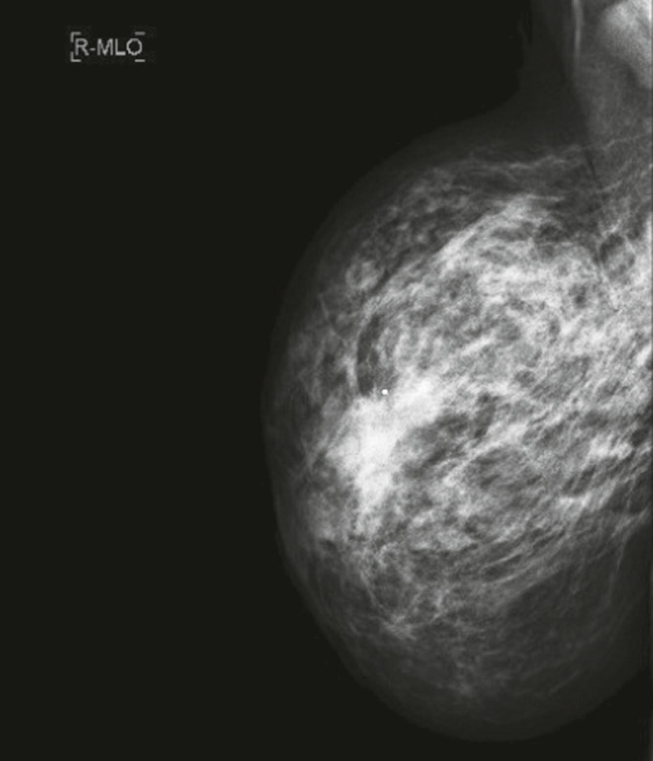 Fig. 15.3, Mammogram showing an abnormal, asymmetric breast mass.