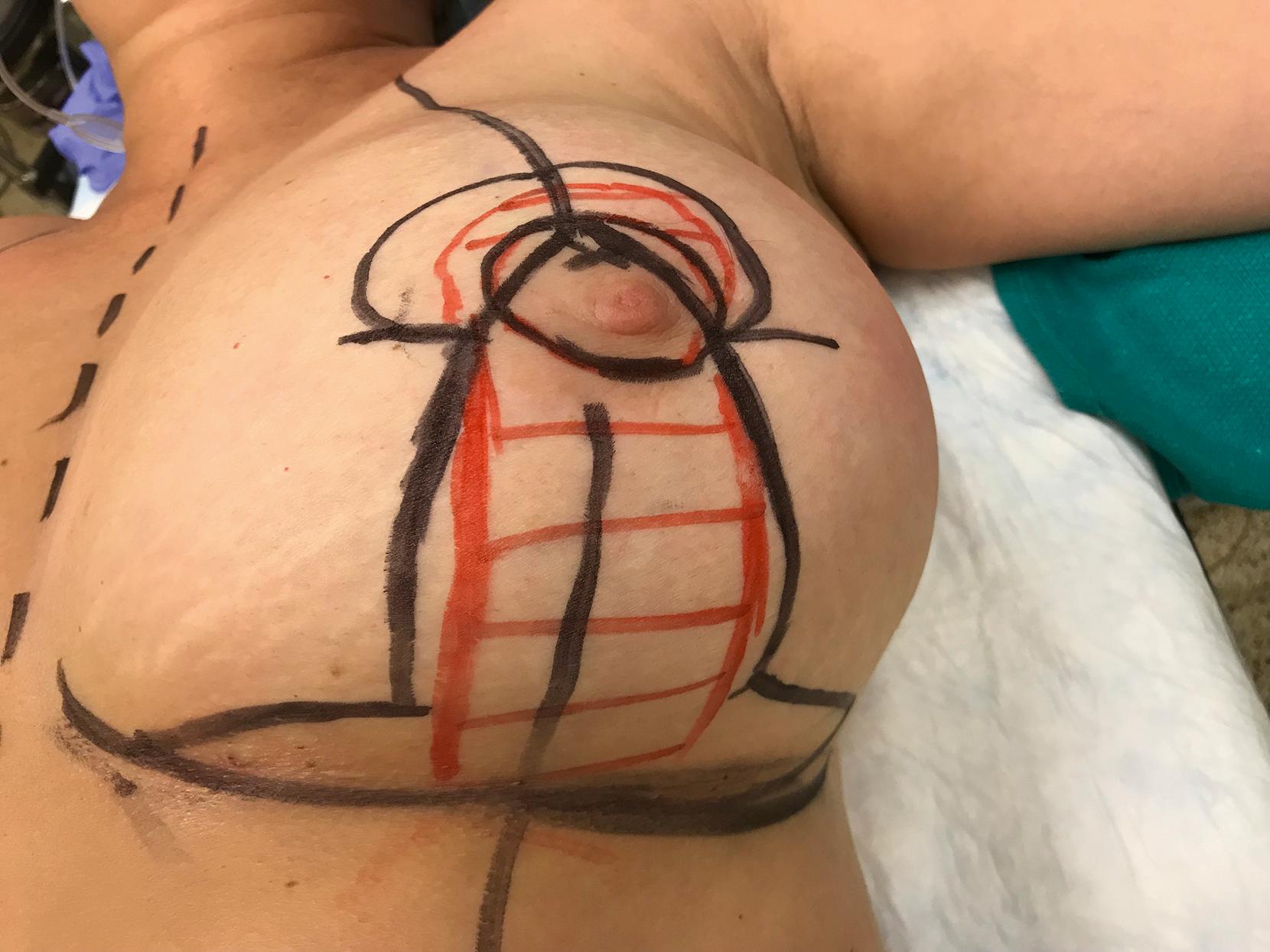 Fig. 15.9, Inferior pedicle markings shown in red marker. The inferior pedicle extends down to the IMF. The inverted-T mastopexy markings and planned NAC position are shown in black marker.