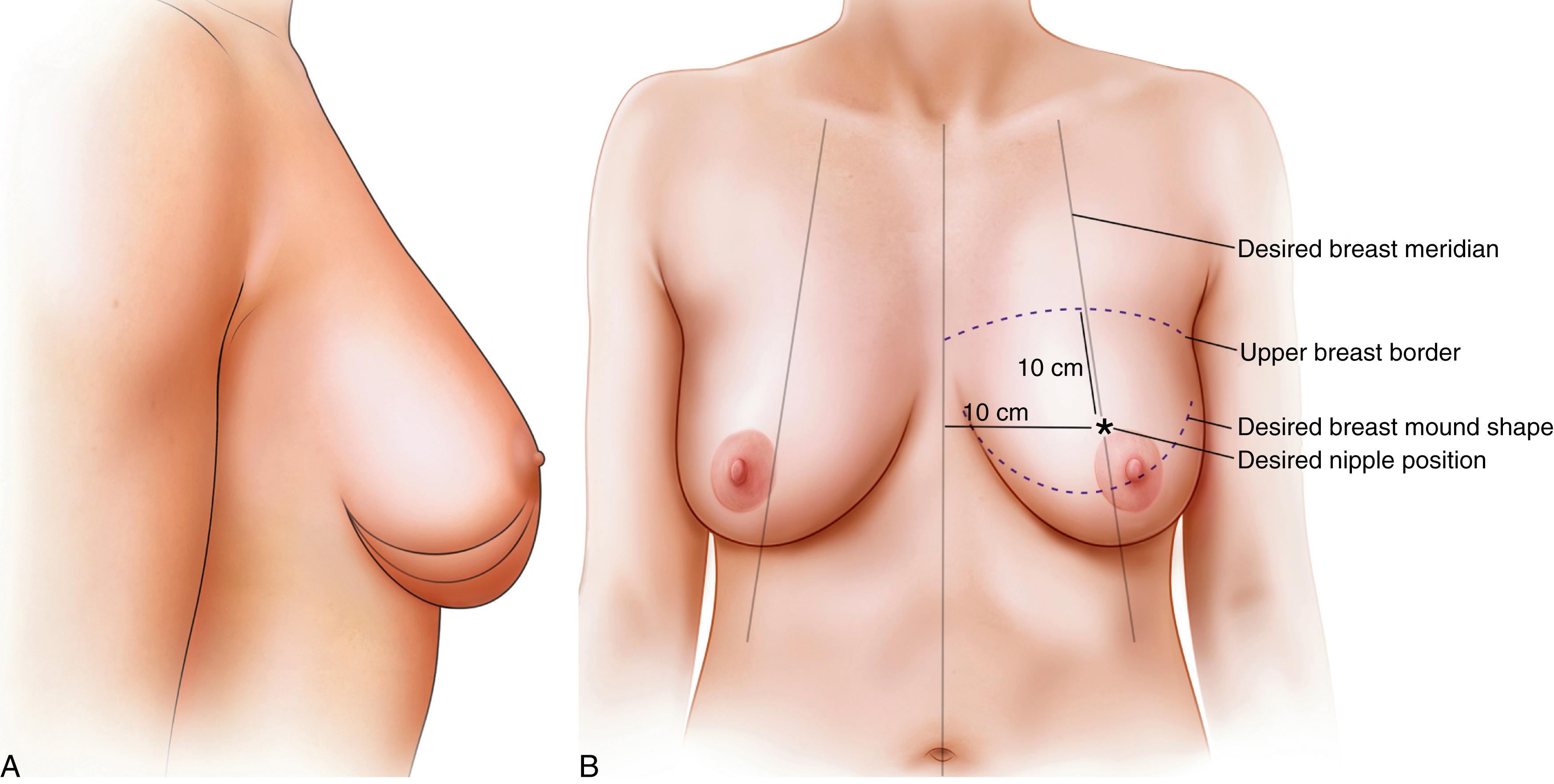 Fig. 38.1, Principles. (A) The upper breast border does not change in a breast reduction or mastopexy. The key to a good result is for the surgeon to understand that the excess in the lower pole needs to be “removed” in a breast reduction or “moved” in a mastopexy. (B) The surgeon can visualize the shape of the final result by marking what is desired. The excess beyond that shape needs to be removed in a breast reduction. The ideal nipple position should be determined at about 10 cm below the upper breast border (since this remains unchanged) in an average “C” cup breast. The new breast meridian should be drawn where it “should” be, not where it exists and the ideal breast meridian is about 10 cm from the chest midline (straight, not around the curve of the breast) in the “average” patient.