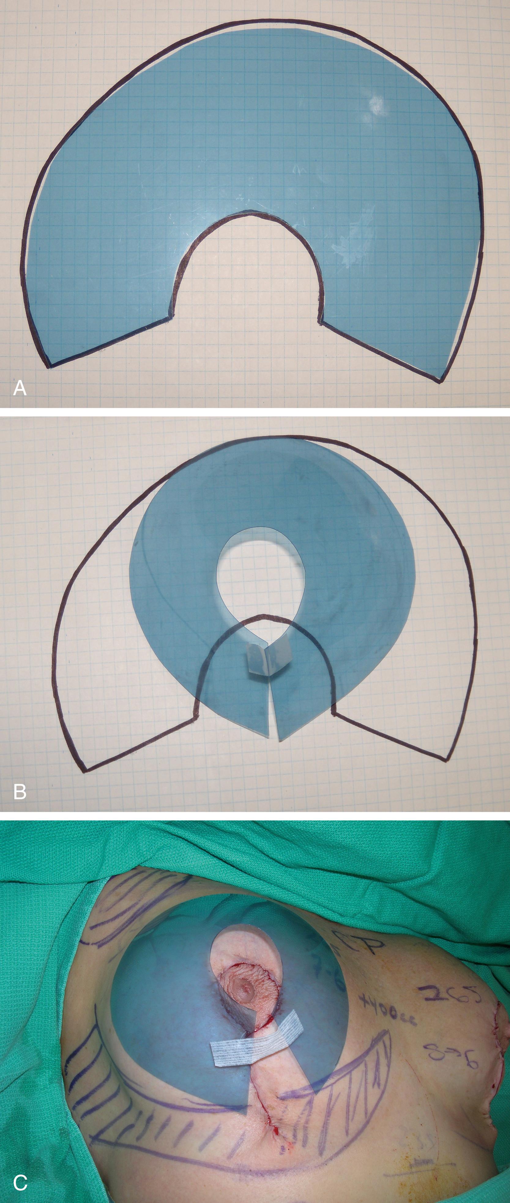 Fig. 38.2, The “Wise” pattern. The Wise pattern was adapted from a deconstructed brassiere by Dr Robert Wise 5 and it forms the basis of an ideal breast shape. Once the flat pattern is coned (by removing or moving the inferior wedge) a good shape with good projection is achieved. (A) The Wise pattern. (B) The Wise pattern coned. (C) The Wise pattern is an excellent design for what should be left behind to achieve a good breast shape rather than using it as a skin brassiere pattern.