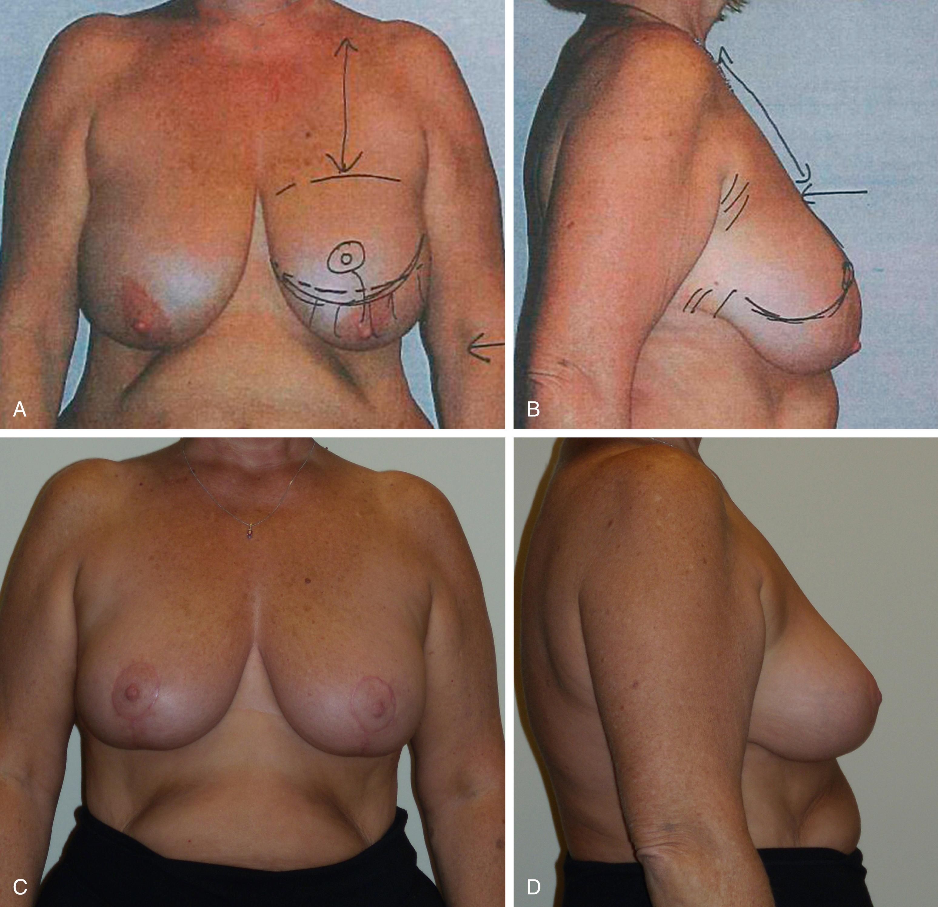 Fig. 38.3, Managing patient expectations through consultation photographs. Patient photographs taken at consultation can be used to manage patient expectations. Once the surgeon understands that the upper breast border will not change, the expected result can be drawn on the preoperative photograph. More projection can be achieved by coning the breast tissue after the inferior wedge is removed. The breast cannot be elevated on the chest wall and the upper pole cannot be filled, but the angle (projection) can be increased. The surgeon will also know if tissue needs to be removed in the upper pole in the occasional patient where reduced projection is desired. (A) Preoperative frontal breast reduction candidate showing the desired final breast shape with inferior and lateral tissue removed. (B) Preoperative lateral of same breast reduction candidate showing the patient that the upper breast does not change but the lower pole is removed. (C) Postoperative view of same patient showing the postoperative result. The frontal view matches the preoperative drawing. (D) Postoperative view of same patient showing the postoperative result. The lateral view matches the preoperative drawing. The breast footprint remains unchanged but the glandular ptosis is corrected and the nipple repositioned to the most projecting part of the breast.