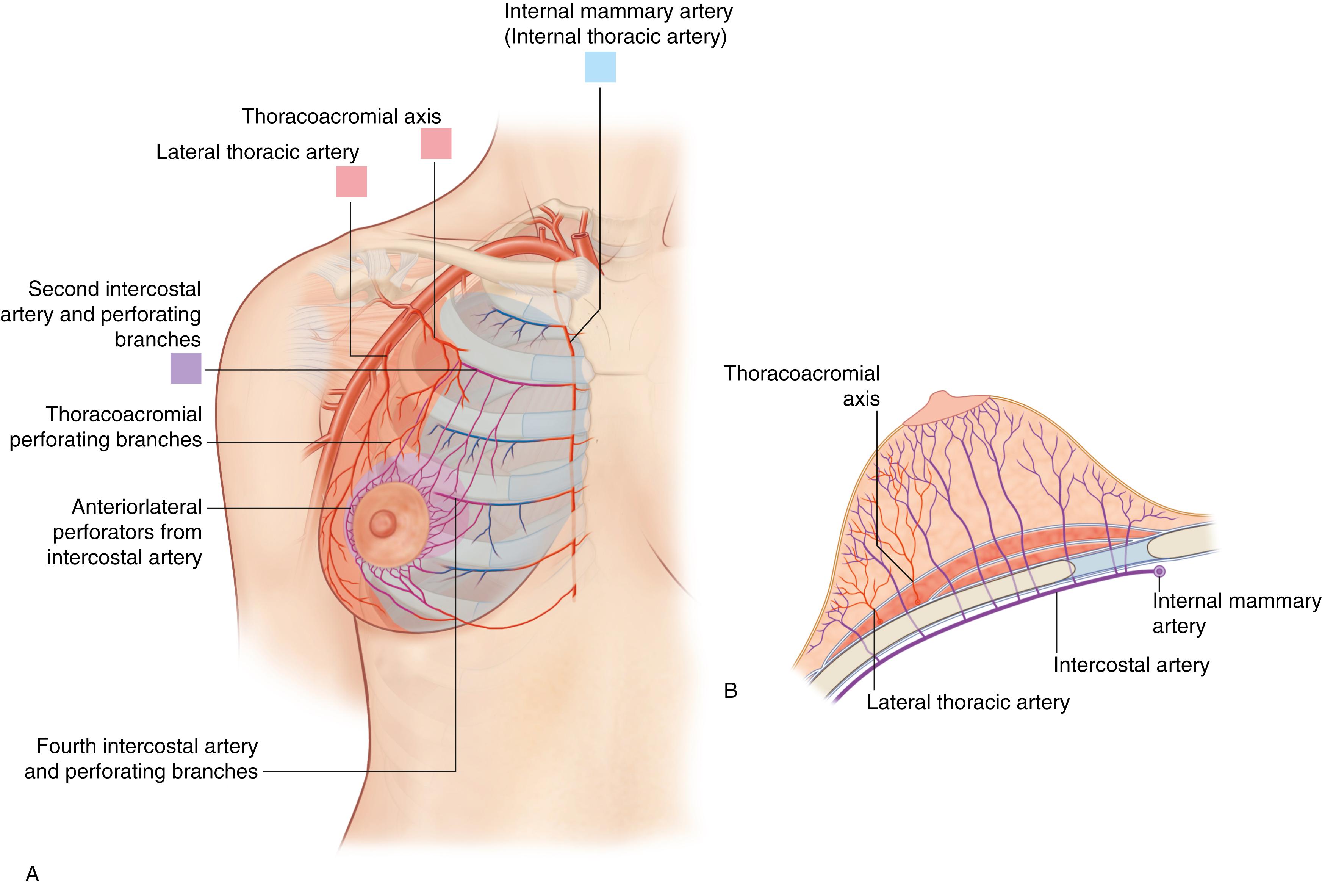 Fig. 38.4, Blood supply. The major blood supply to the breast comes from the internal mammary (thoracic) system. There is also some contribution from the superficial branch of the lateral thoracic artery. (A,B) The arteries penetrate up from the chest wall around the periphery of the breast and then they pass around the breast parenchyma itself, up in the subcutaneous tissue. The arteries are superficial as they course toward the areola. The veins are even more superficial as they course just under the dermis (and are often visible through pale skin) with the majority draining superomedially. The branch of the internal mammary artery from the fourth interspace actually penetrates directly up into the breast parenchyma just medial to the breast meridian just above the fifth rib. This artery has accompanying venae comitantes. This makes sense because the breast is a fourth interspace structure attached to the skin at the nipple and sliding loosely over the pectoralis fascia. The breast is held in place by skin–fascial structures at the IMF and over the sternum. The superior and lateral aspects of the breast slide freely over the underlying tissues.