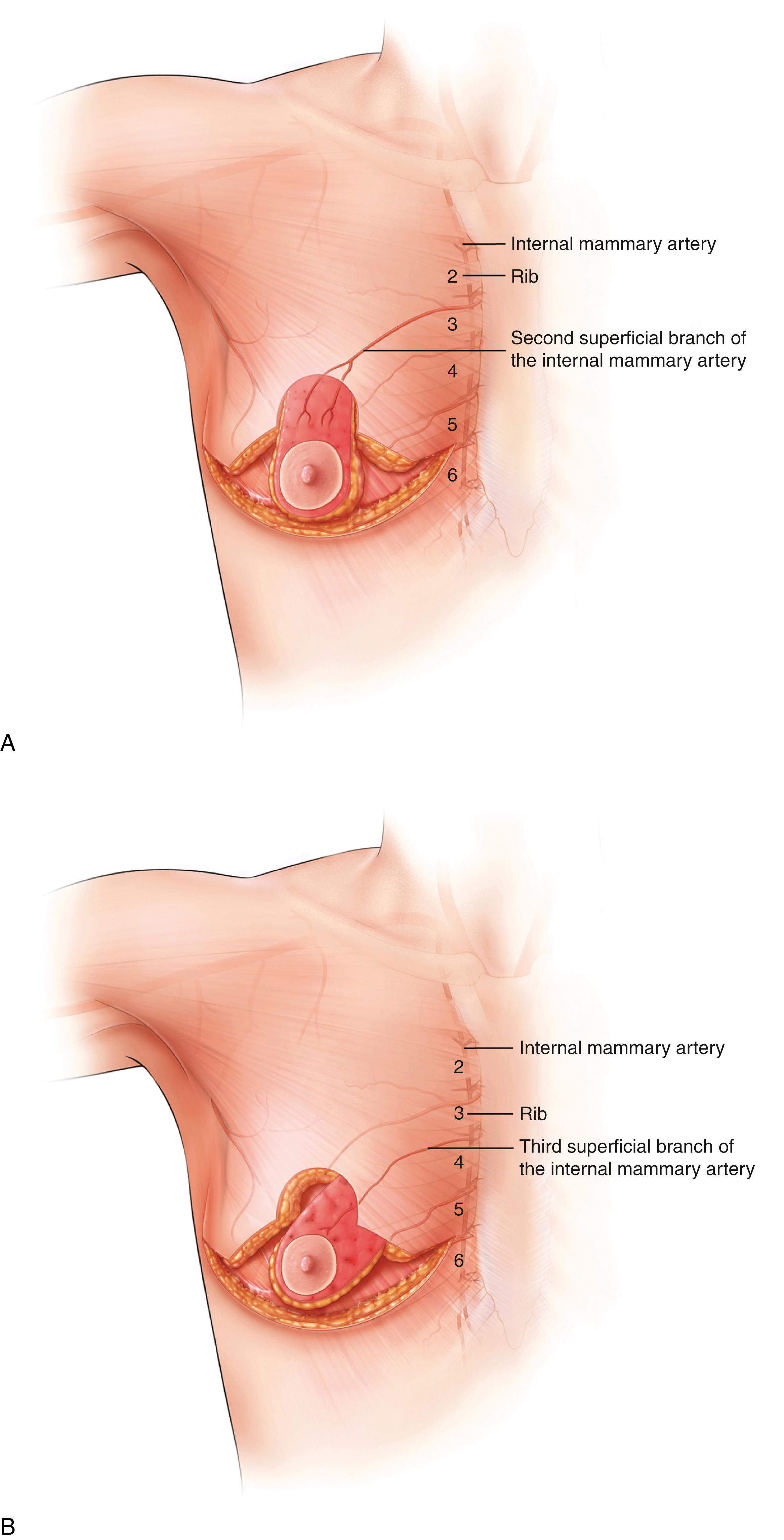 Fig. 38.5, The various pedicle designs for the nipple and areolar complex. The four classic pedicle designs. (A) Superior pedicle: The blood supply comes from the descending branch of the internal mammary (thoracic) system at the second interspace. (B) Medial pedicle: The blood supply comes from the third interspace branch of the internal mammary system. (C) Inferior pedicle: The blood supply comes from the perforator that comes up at the fourth interspace, along with its venae comitantes. This deep branch also comes from the internal mammary system. There are also blood vessels that come up through the IMF. (D) Central pedicle: The central pedicle has a more restricted blood supply than an inferior pedicle because it does not have the vessels coming through the IMF. (E) Lateral pedicle: The blood supply comes from the superficial branch of the lateral thoracic artery. (F) A true superomedial pedicle combines both superior and medial pedicles to include two axial arteries. The majority of the venous drainage is superomedial.