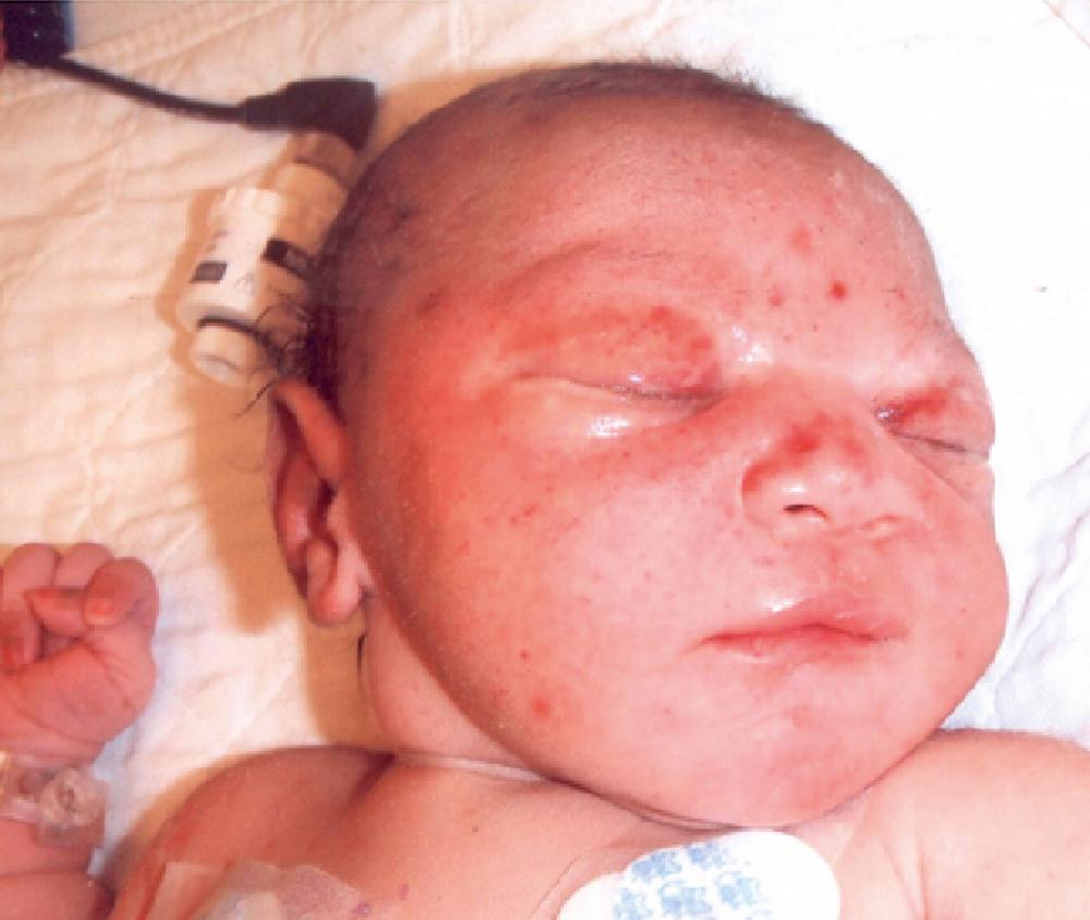 Figure 51.1, Symptomatic cytomegalovirus (CMV) in a neonate.