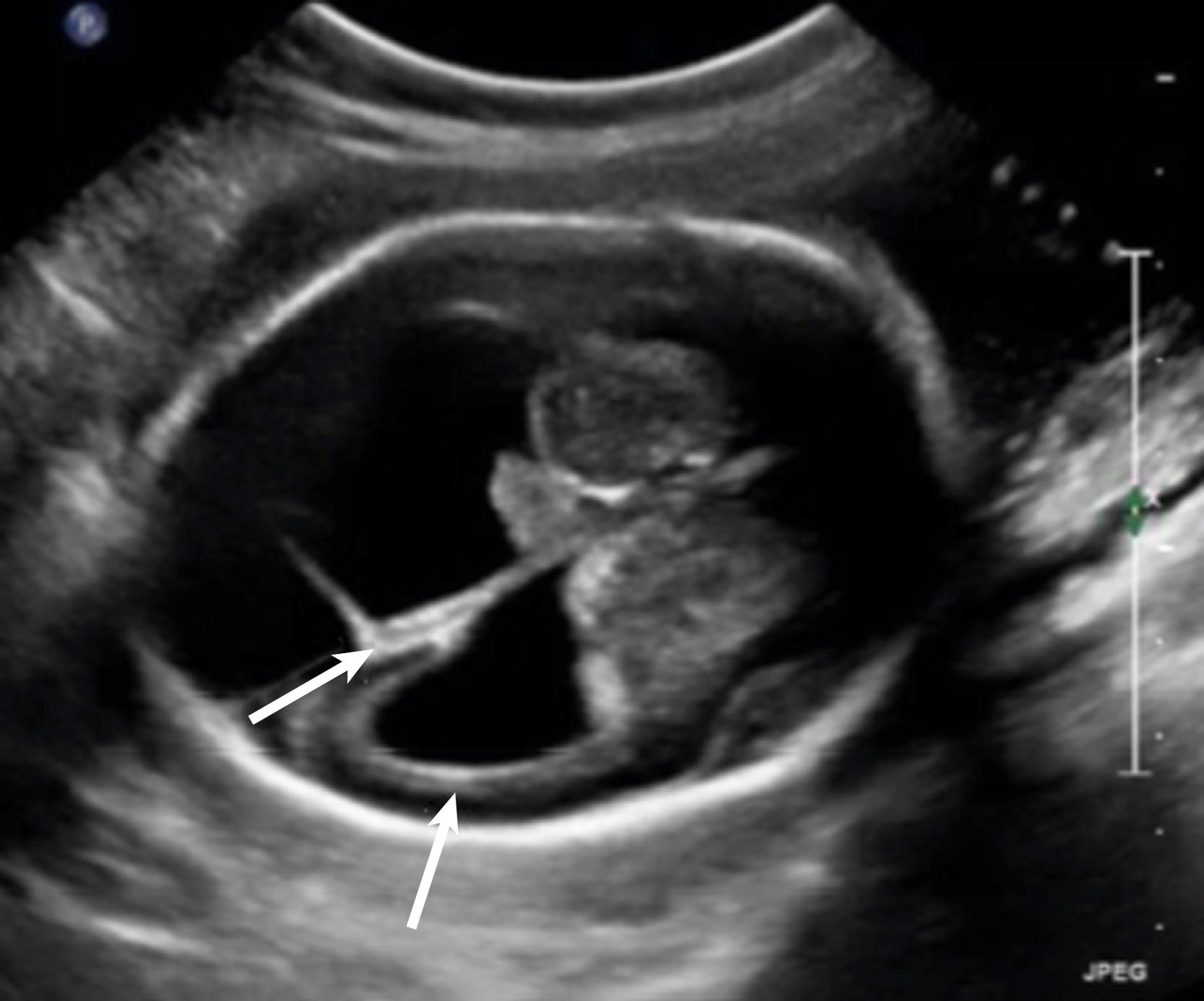 Figure 51.3, Ultrasound of a fetus with congenital toxoplasmosis.