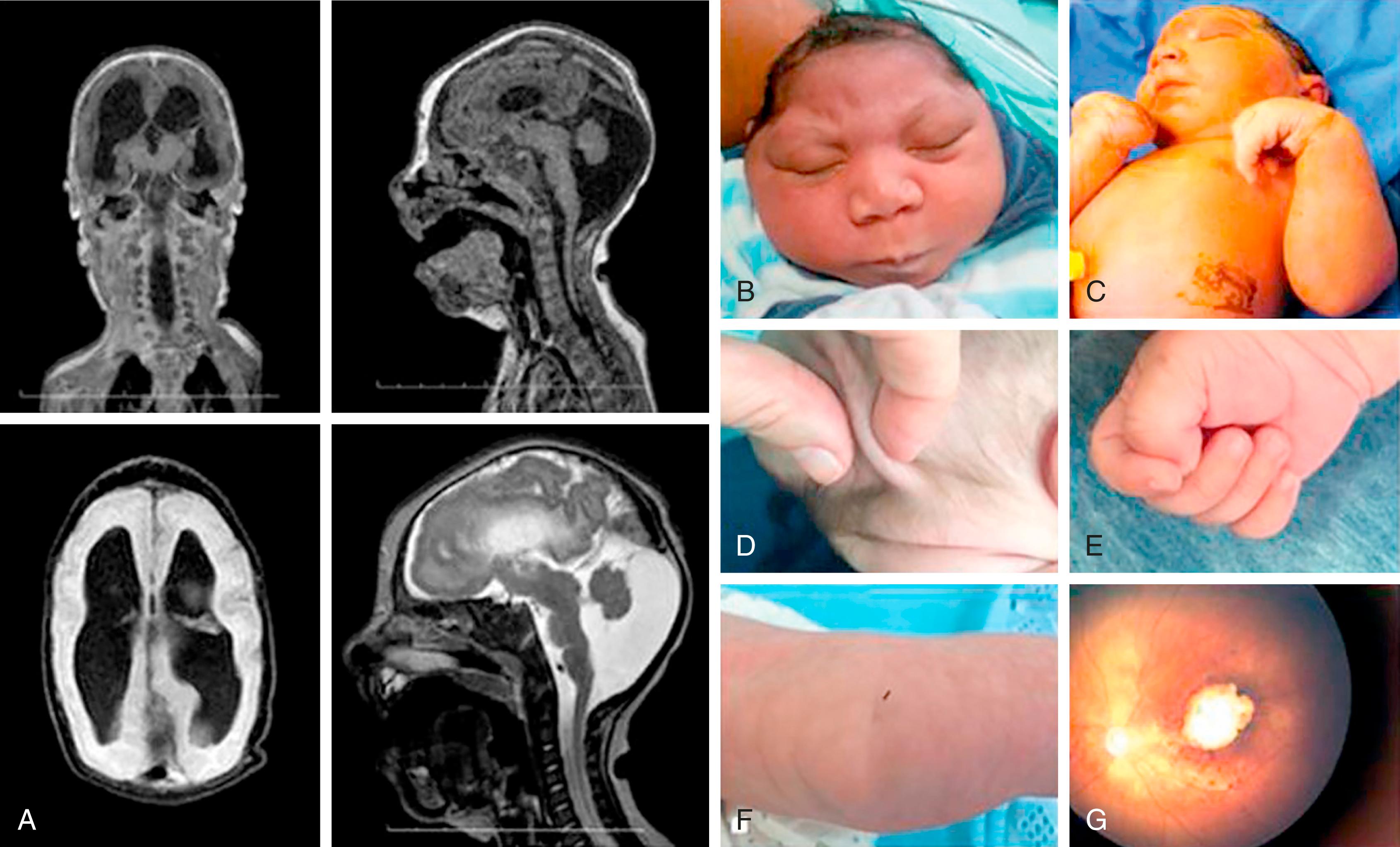 Figure 49.2, Clinical manifestations of congenital Zika virus syndrome.