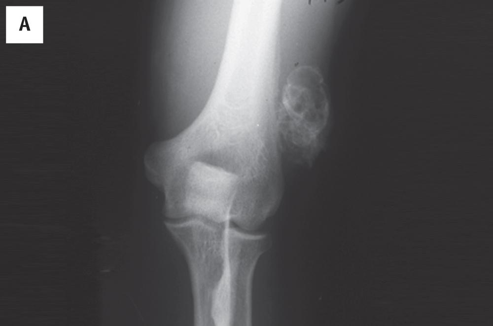 Fig. 12.1, (A) Myositis ossificans occurring within the brachialis muscle. Note the well-formed shell of bone. (B) The same mass, bisected. The center has the appearance of normal cancellous bone.