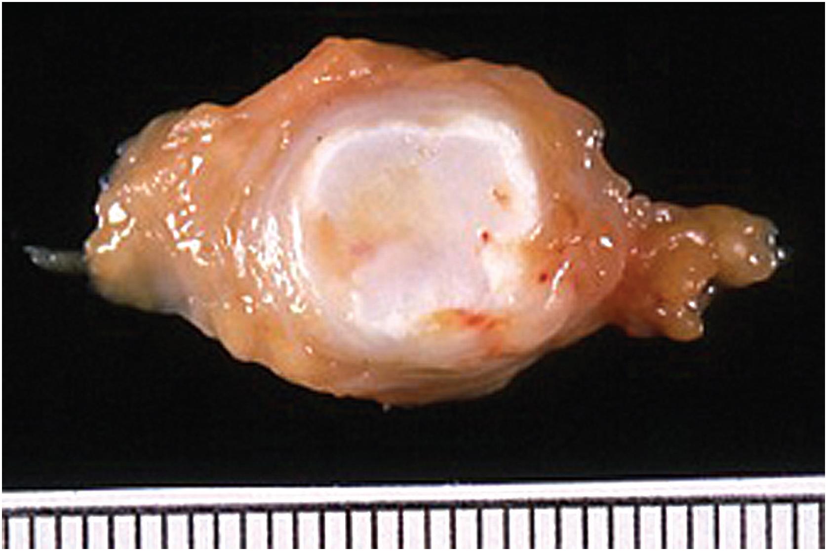 Fig. 12.2, Fibro-osseous pseudotumour, appearing as a small, circumscribed, rubbery nodule with adherent fat.