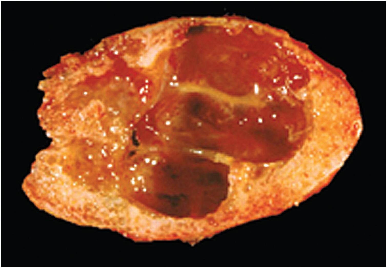 Fig. 12.3, Soft tissue aneurysmal cyst with a shell of bone and central hemorrhagic cystic cavities.