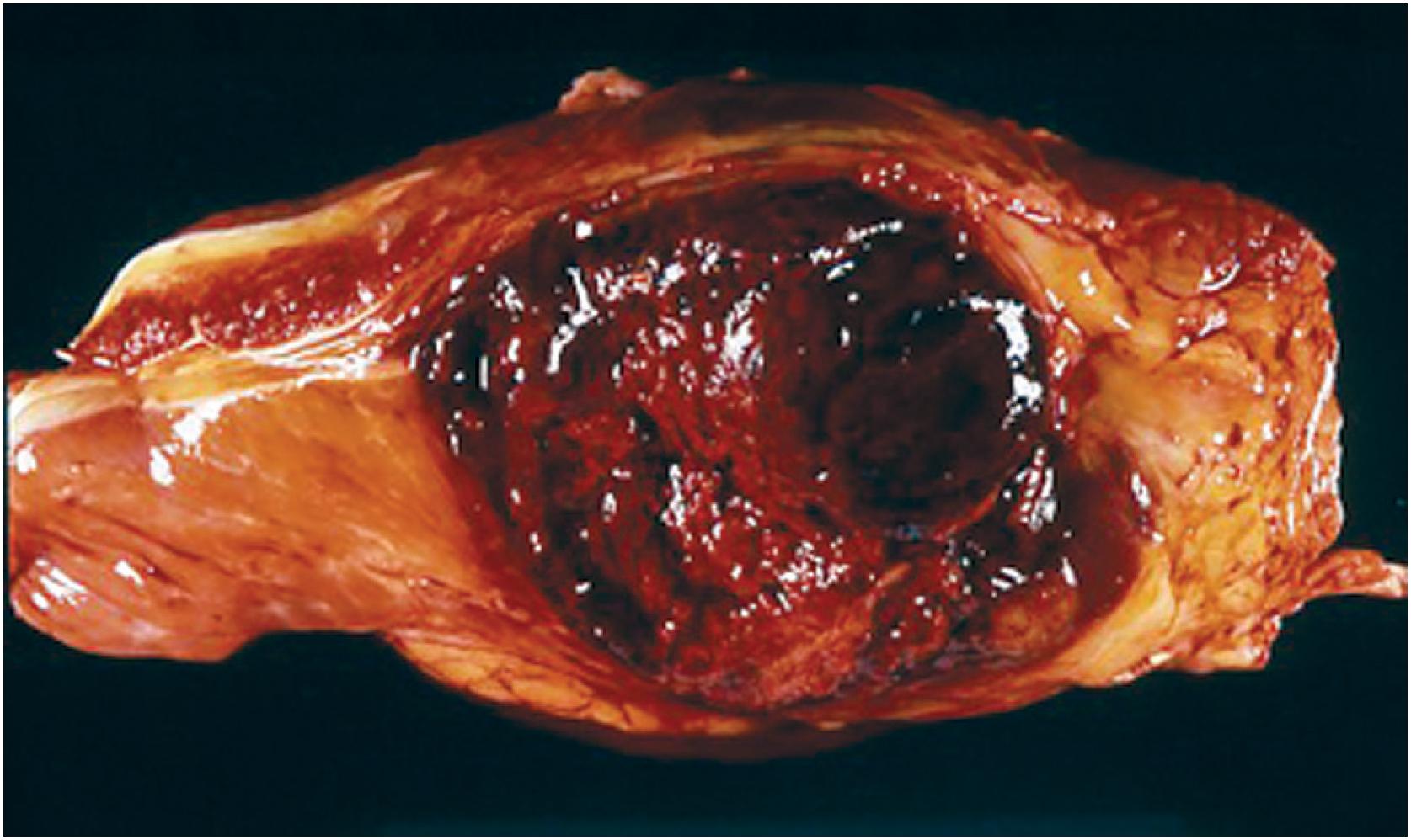 Fig. 12.6, Soft tissue osteosarcoma, presenting as a hemorrhagic and necrotic soft tissue mass without grossly apparent bone formation.