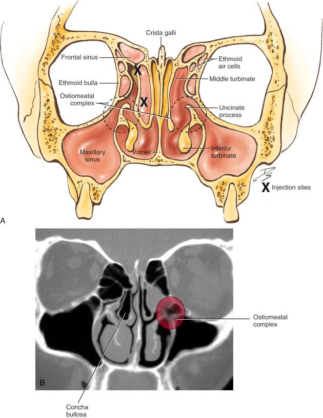 Fig. 6.1, (A) Drawing in coronal view of the middle turbinate, uncinate, and ostiomeatal complex. Dashed circles represent the ostiomeatal complexes. Local anesthetic should be infiltrated at both X s, which correspond to the axilla of the middle turbinate as it attaches to the lateral nasal wall, and injected into the anterior face of the middle turbinate itself. (B) Coronal CT scan showing bilateral conchae bullosae, which are air cells inside the middle turbinate.