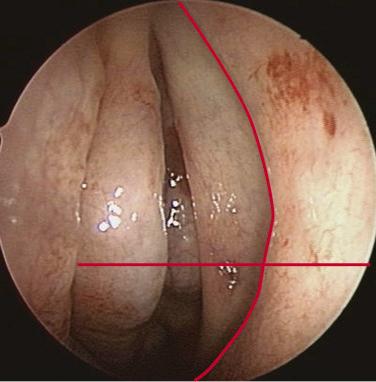 Fig. 6.4, Endoscopic photograph illustrating how to locate the maxillary os.