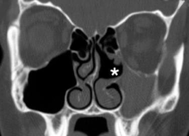 Fig. 6.5, Coronal CT scan showing a lateralized left uncinate process (asterisk). With the decreased maxillary volume and low orbital floor, this CT scan is consistent with maxillary atelectasis or silent sinus syndrome.