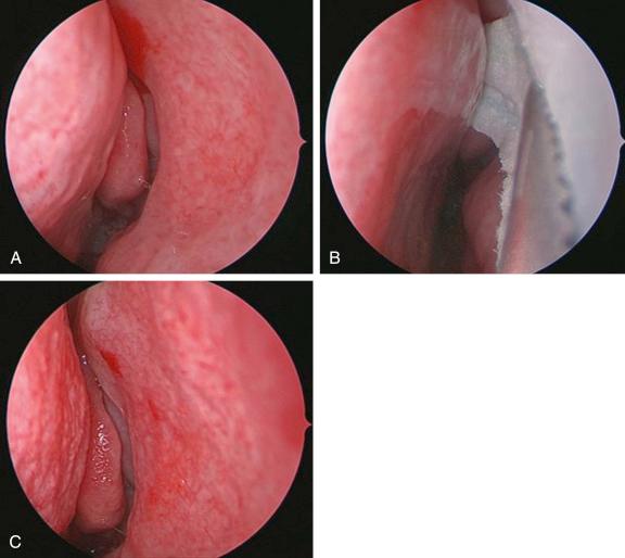 Fig. 6.7, (A–C) Accurate placement of decongestive pledgets will allow better visualization of the middle meatus. Here, endoscopic placement of the pledgets superiorly will allow for adequate decongestion of the nasal swell body, thus improving visualization of the superior attachment of the middle turbinate and the superior middle meatus.