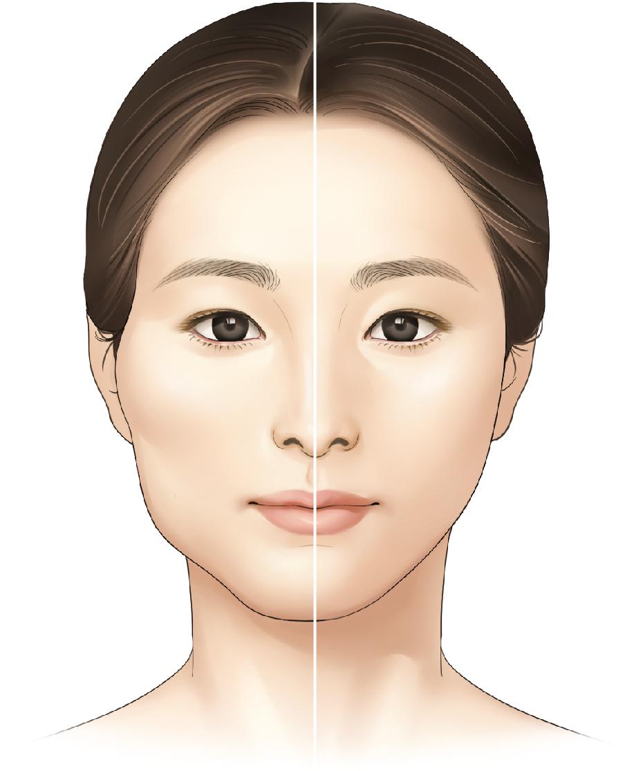 Fig. 23.1, This image contrasts common Asian features (left) against the smooth oval features (right). Contouring procedures allow the surgeon to create this change in facial shape.