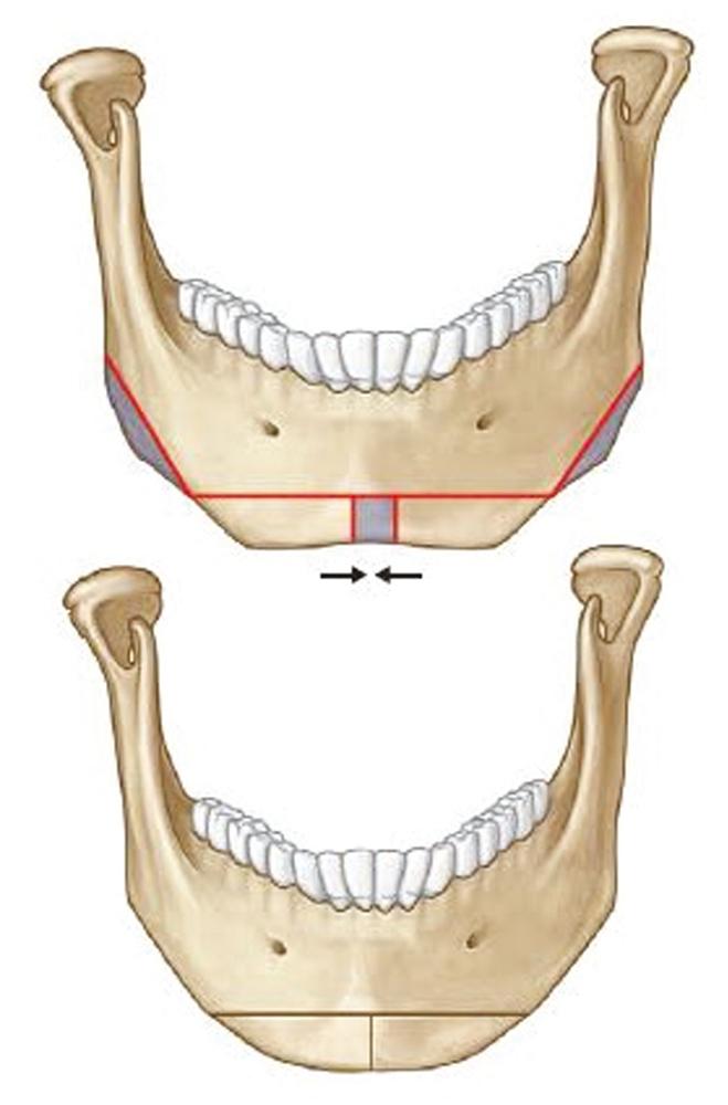 Fig. 23.2, The combination of narrowing genioplasty and gonial angle reduction is a powerful method to create the tapered “inverted egg” oval shape desired by Asians and women.