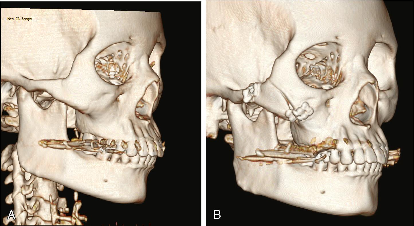 Fig. 23.4, Our preferred method for malar reduction. An osteotomy is made with no bone removal: (A) preoperative CT scan (B) the bone is repositioned and secured with rigid fixation.