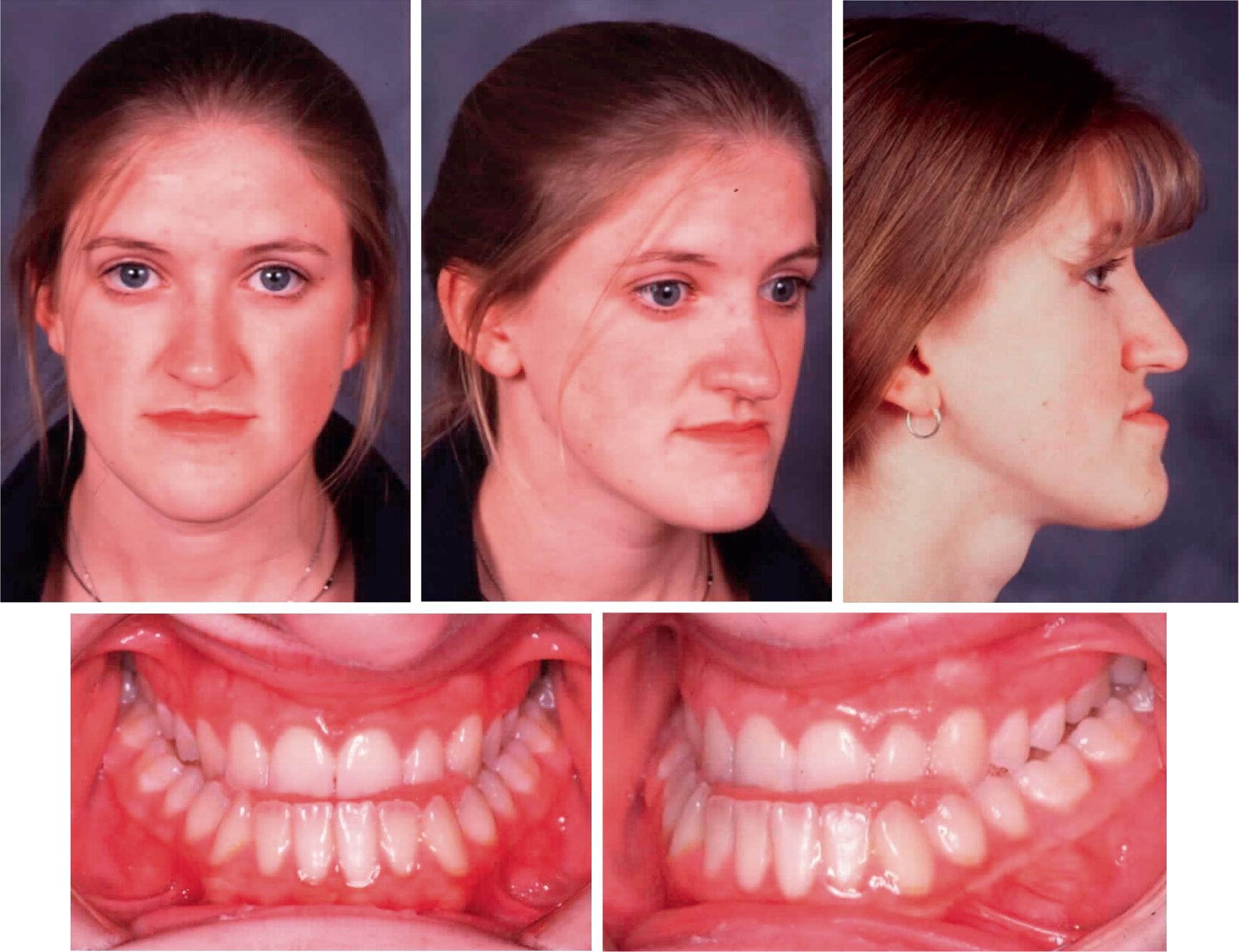 Fig. 20.1, Patient will typically ask for mandibular surgery to correct the occlusion (case of Pravin K. Patel, MD).