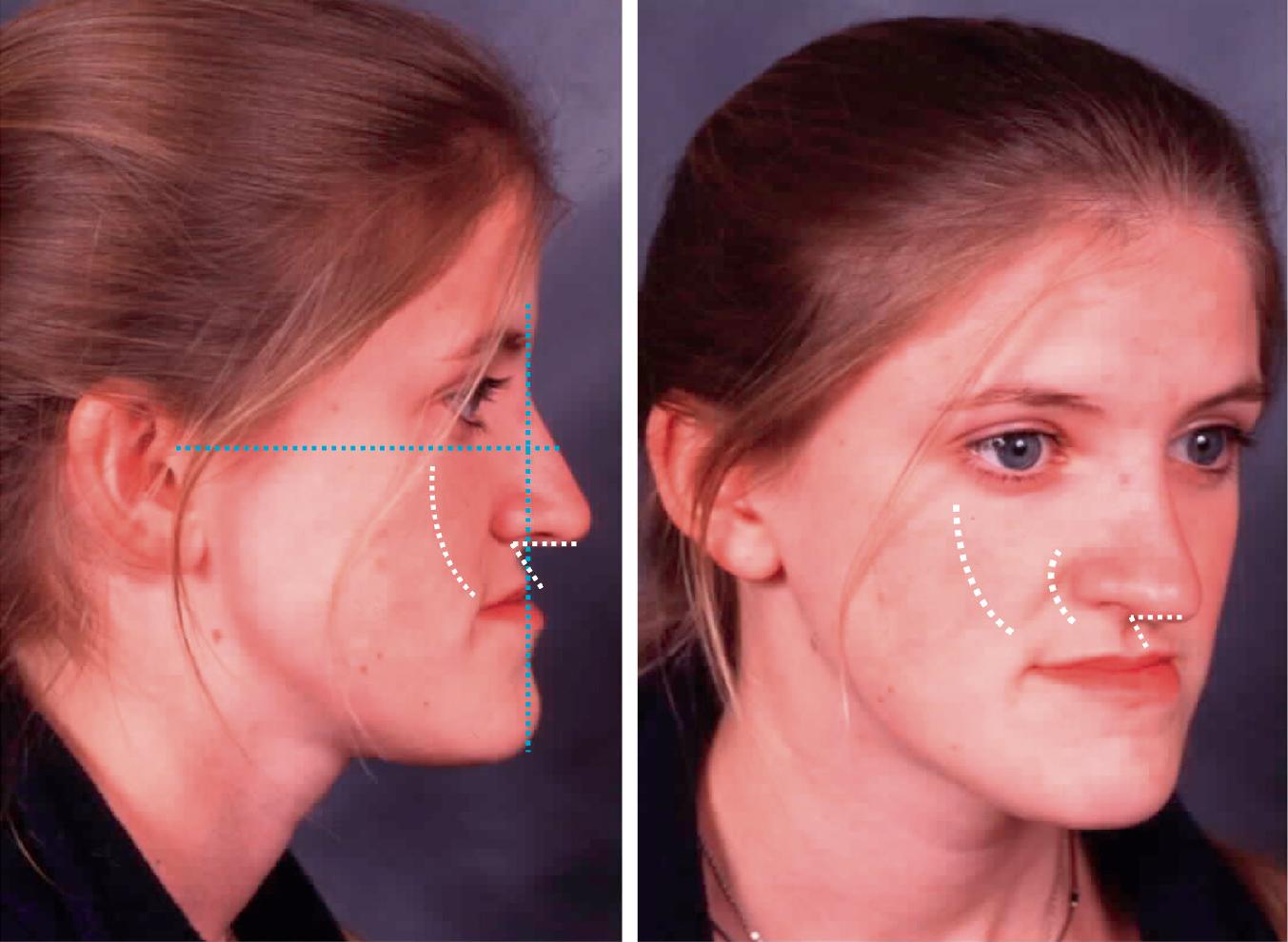 Fig. 20.2, Careful clinical examination will reveal the acute nasolabial angle, the shortened upper lip, and middle-third vertical deficiency in the profile view. The three-quarter view best reveals the perialar deficiency and the midfacial deficiency that involves the maxilla and extends to involve the malar region. The three-quarter view is the single most important view to assess the curvatures of the face. The patient’s mandibular prognathism results from mandibular overclosure.