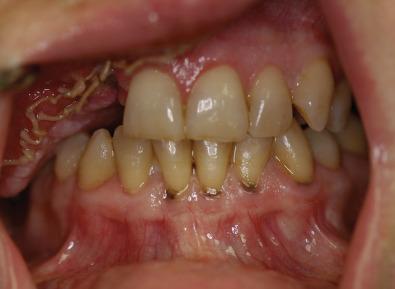 Fig. 3.11.2, Teeth opposing the reconstructed site contacting the free flap reconstruction. This can cause severe damage to the tissue and should be avoided.