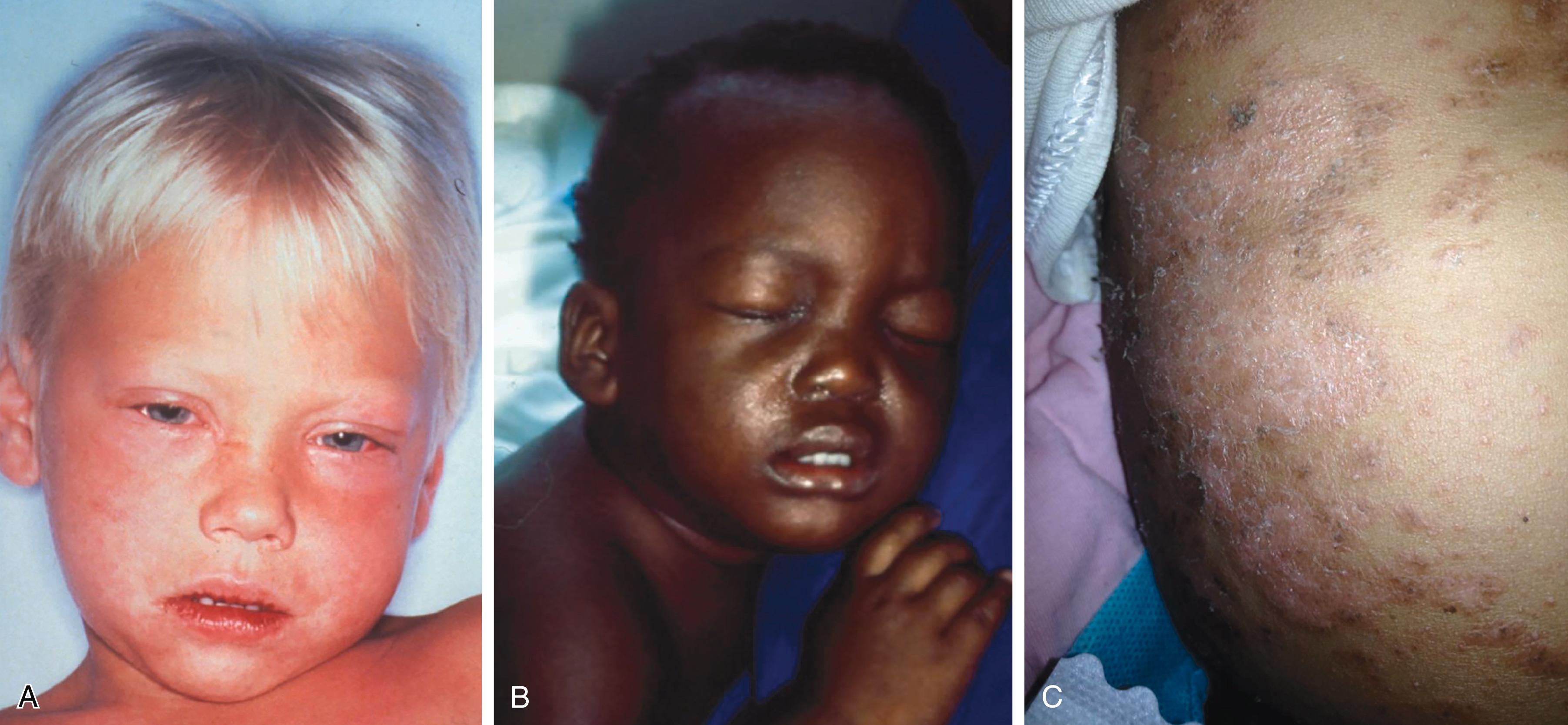 FIGURE 338-3, The variable rash of measles. A , Classic erythematous rash, conjunctivitis, and coryza. B , Rash is difficult to perceive on dark skin, but patient has typical conjunctivitis and coryza. C , Prolonged desquamating dermatitis in a malnourished child with measles.