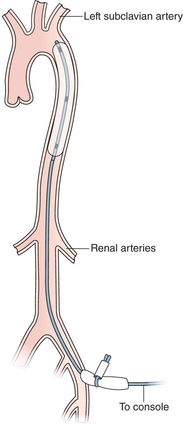 Fig. 22.2, The intraaortic balloon pump.