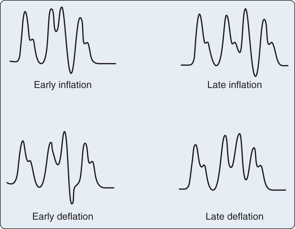 Fig. 22.4, Intraaortic balloon pump (IABP) timing errors. Early inflation, before the dicrotic notch (ie, before systolic ejection is completed) immediately forces the aortic valve closed, resulting in prematurely terminated systolic ejection. This results in decreased stroke volume for that cardiac cycle and increased preload for the next cardiac cycle. Not only does this reduce an already impaired cardiac output, but acutely increased end-diastolic volumes stress the failing ventricle by increasing wall tension, which can increase myocardial oxygen demand, impair perfusion, and lead to ischemia. Thus early inflation must be corrected because it increases myocardial oxygen demand and decreases myocardial oxygen supply. Late inflation, after the dicrotic notch, fails to augment coronary perfusion pressure optimally. Thus myocardial oxygen supply is not maximally enhanced. Early deflation allows time for aortic root pressure to return to baseline before systolic ejection and therefore fails to decrease impedance to opening the aortic valve. Thus myocardial oxygen demand is not decreased. Recall that it is the decrease in myocardial oxygen demand that most benefits the failing ventricle and allows for increased stroke volume with less myocardial work. Late deflation can be identified by a failure of the pressure to fall back to baseline or, ideally, below baseline, before the next systolic ejection. Late deflation impedes systolic ejection like an aortic cross clamp. The ventricle is forced to develop such a high pressure to open the aortic valve that ventricular wall tension is significantly increased, which increases myocardial oxygen demand, impairs perfusion, and can lead to ischemia.