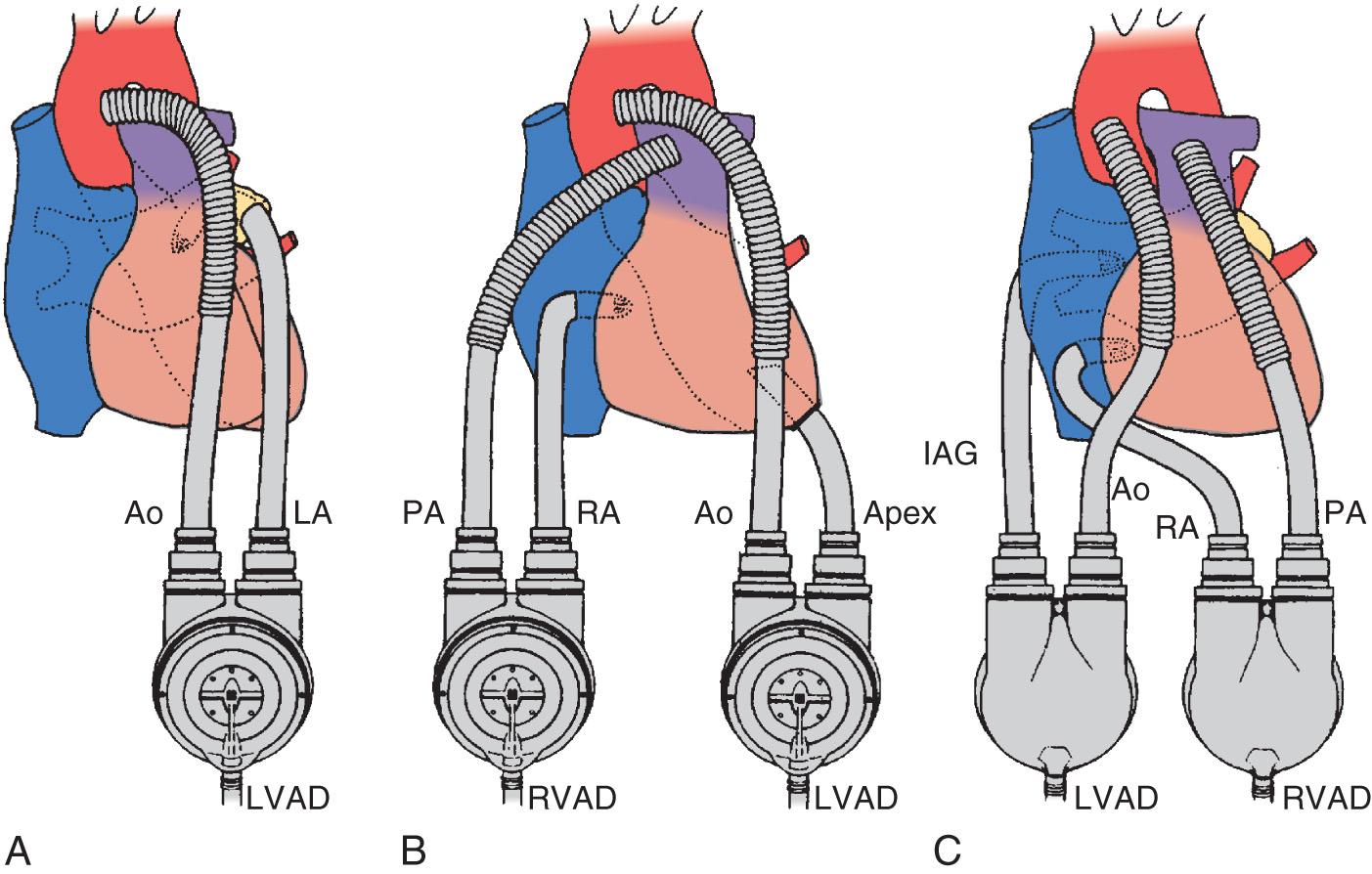 Fig. 22.5, (A–C) Classic cannulation strategies for mechanical circulatory support. Ao, Aorta; IAG, interatrial groove; LA, left atrium; LVAD, left ventricular assist device; PA, pulmonary artery; RA, right atrium; RVAD, right ventricular assist device.