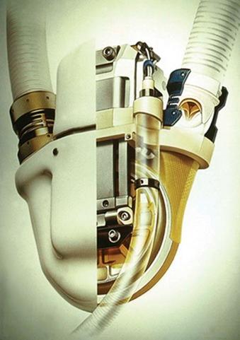 Figure 22-8, Cutaway image of Novacor pump showing sac-type dual pusher-plate pump with modular valved conduits, and integral solenoid energy converter drive with percutaneous vent tube.