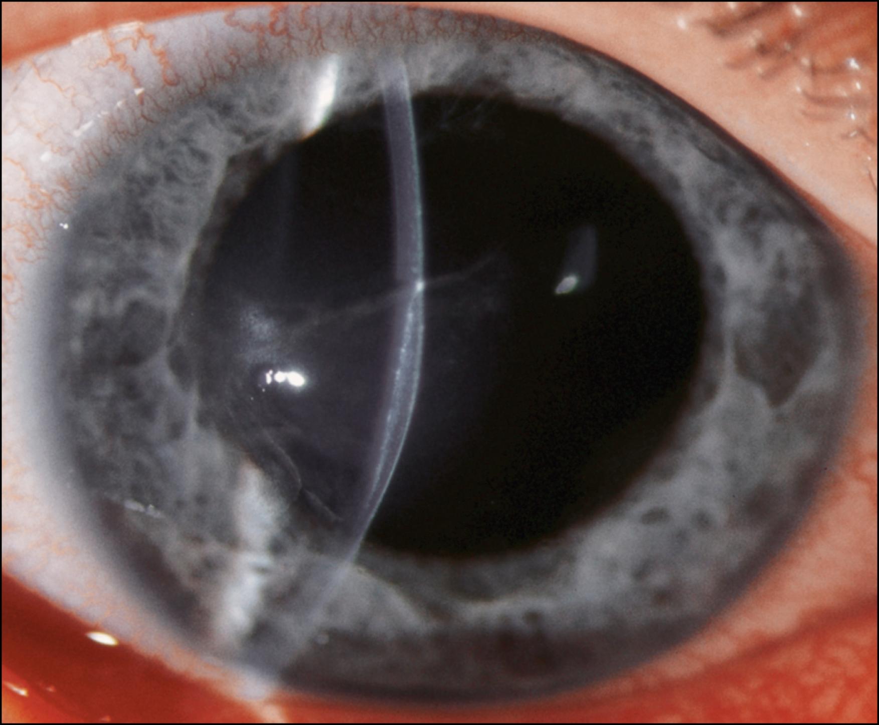 Fig. 94.2, This patient was playing basketball when he was hit in the right cornea by an opponent’s thumbnail, resulting in a corneal flap. This flap is 60%–70% deep at its deepest point. Treatment was limited to the application of a bandage contact lens. This injury healed well without significant corneal opacification or topographic sequelae.