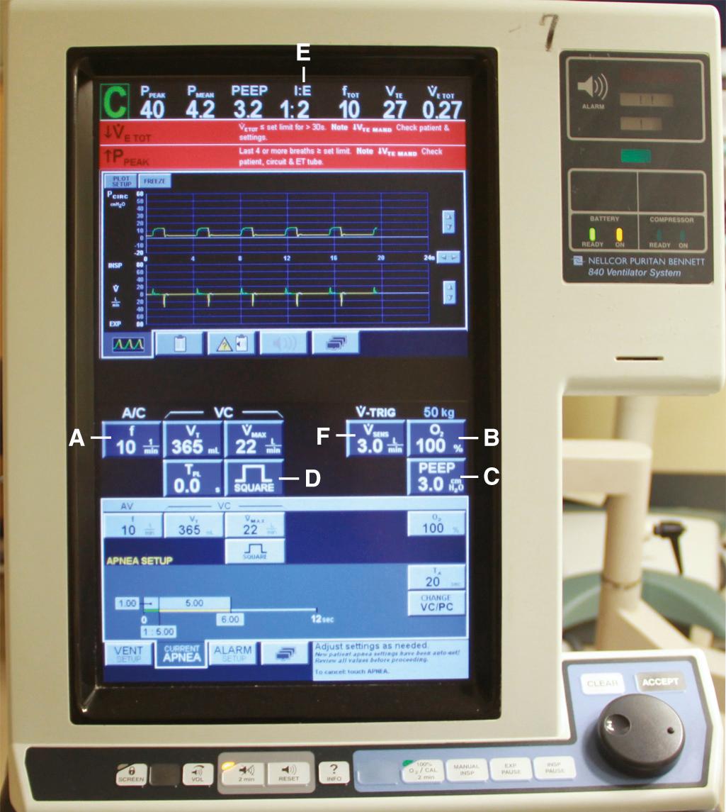 Figure 8.7, The Nellcor Puritan Bennett 840 Ventilator system (Mansfield, MA). Selected features common to all ventilators include the respiratory rate ( A ), F io 2 ( B ), positive end-expiratory pressure (PEEP) ( C ), waveform ( D ), inspiratory-to-expiratory ratio (I/E) ( E ), and trigger ( F ).