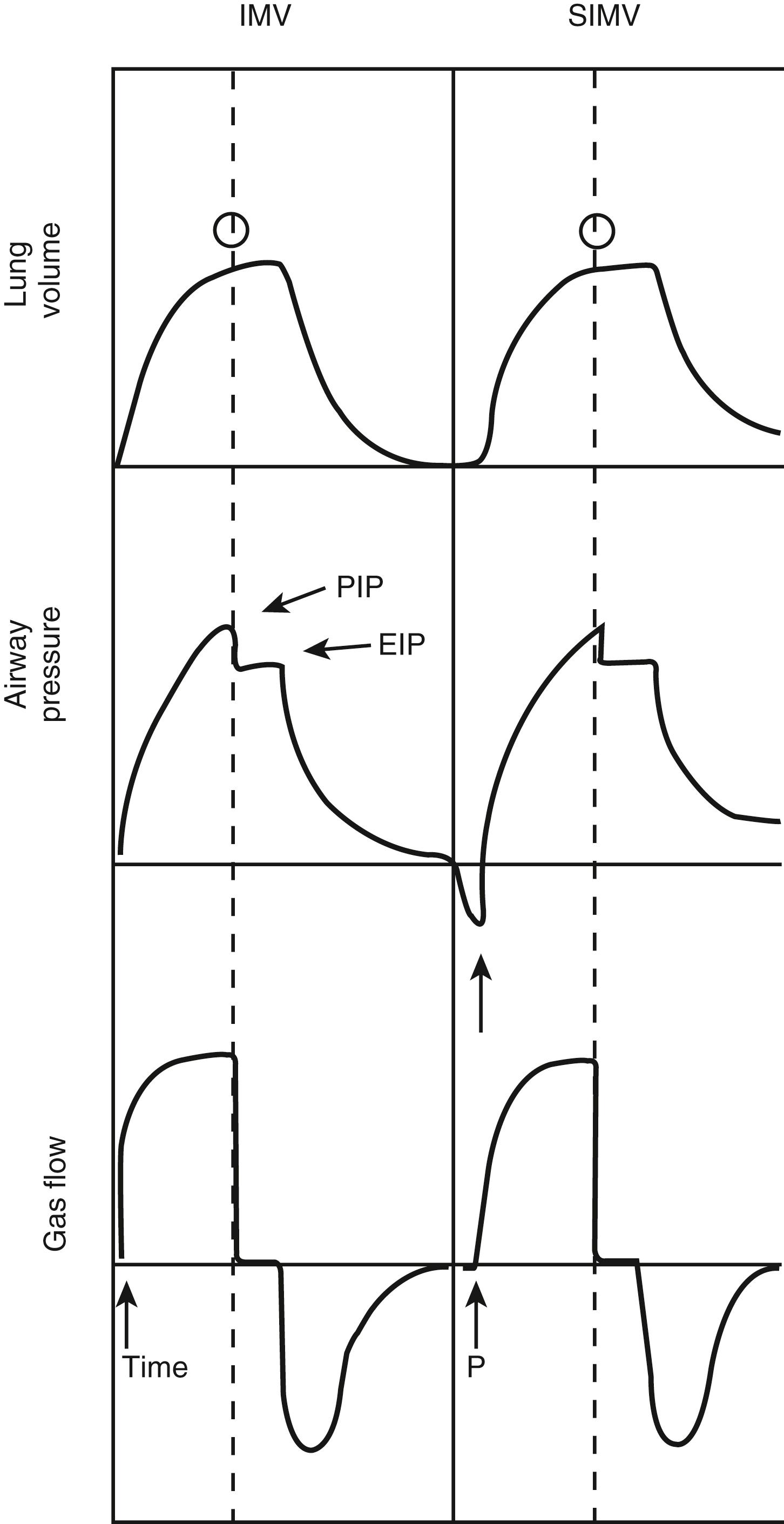 Fig. 7.9, Pressure, volume, and flow waveforms observed during intermittent mandatory ventilation (IMV) and synchronized IMV (SIMV). In this case, an end-inspiratory pause (P) has been added. Note the difference between peak (PIP) and end inspiratory (EIP) or plateau pressure. Arrows, Triggering variables; open circles, cycling variables.