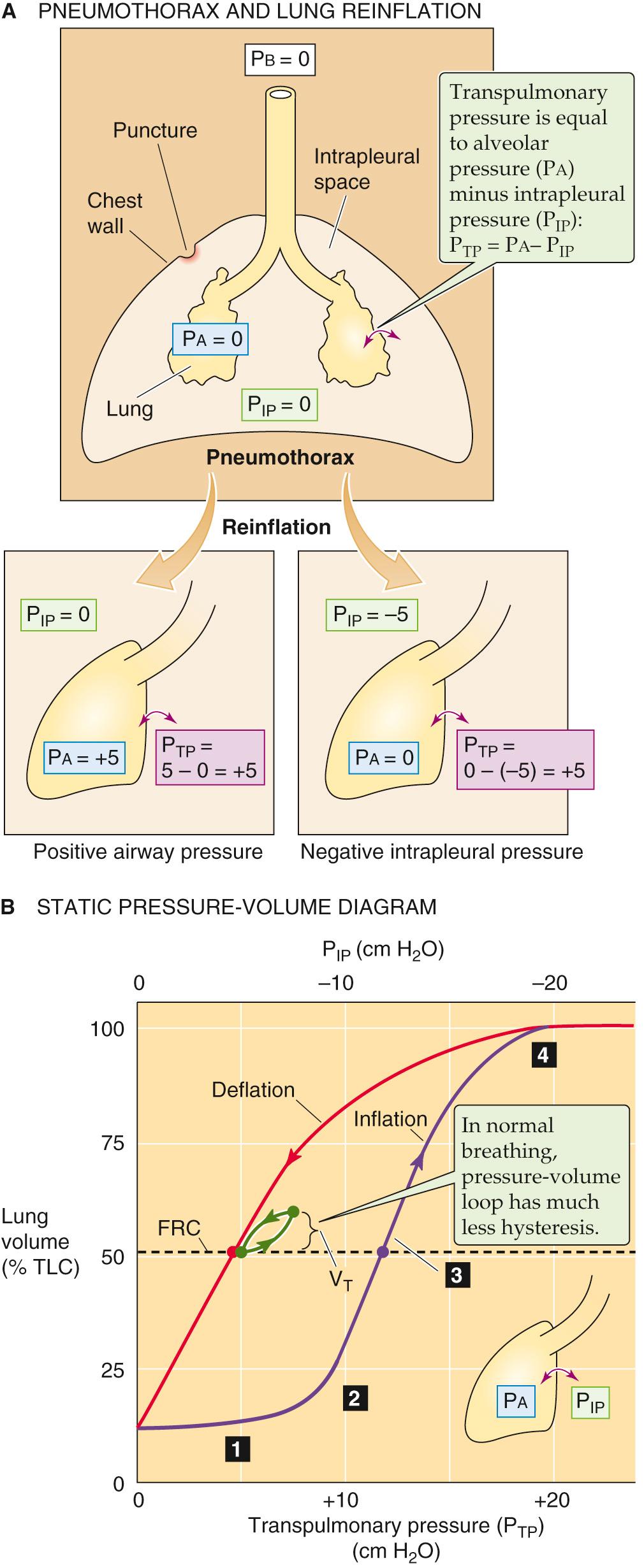 Figure 27-4, Collapse and reinflation of the lungs. In A, we assume that P IP rises to P b , so that P TP falls to zero, collapsing the lungs.
